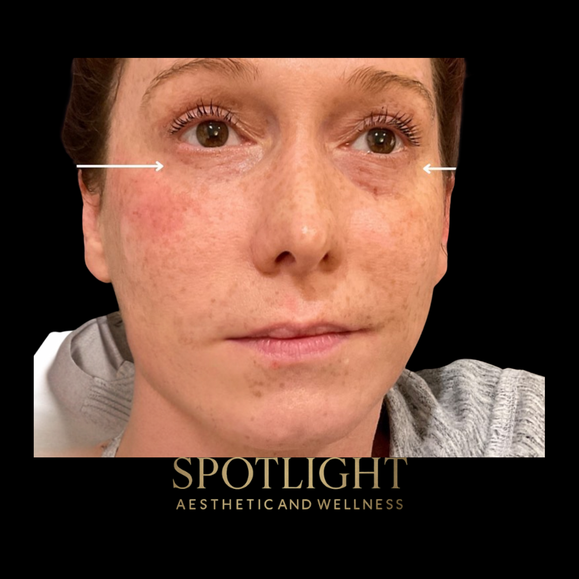 Tear Trough Enhancement - Before and after aesthetic treatment results by Melissa Singleton PA-C