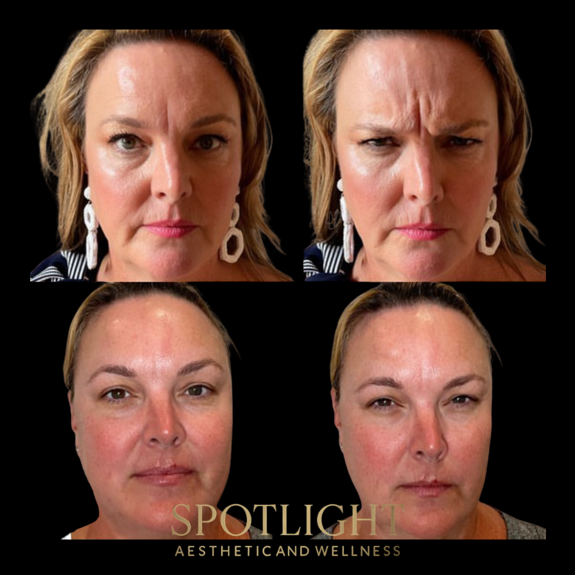 Comprehensive Botox Treatment - Before and after aesthetic treatment results by Melissa Singleton PA-C