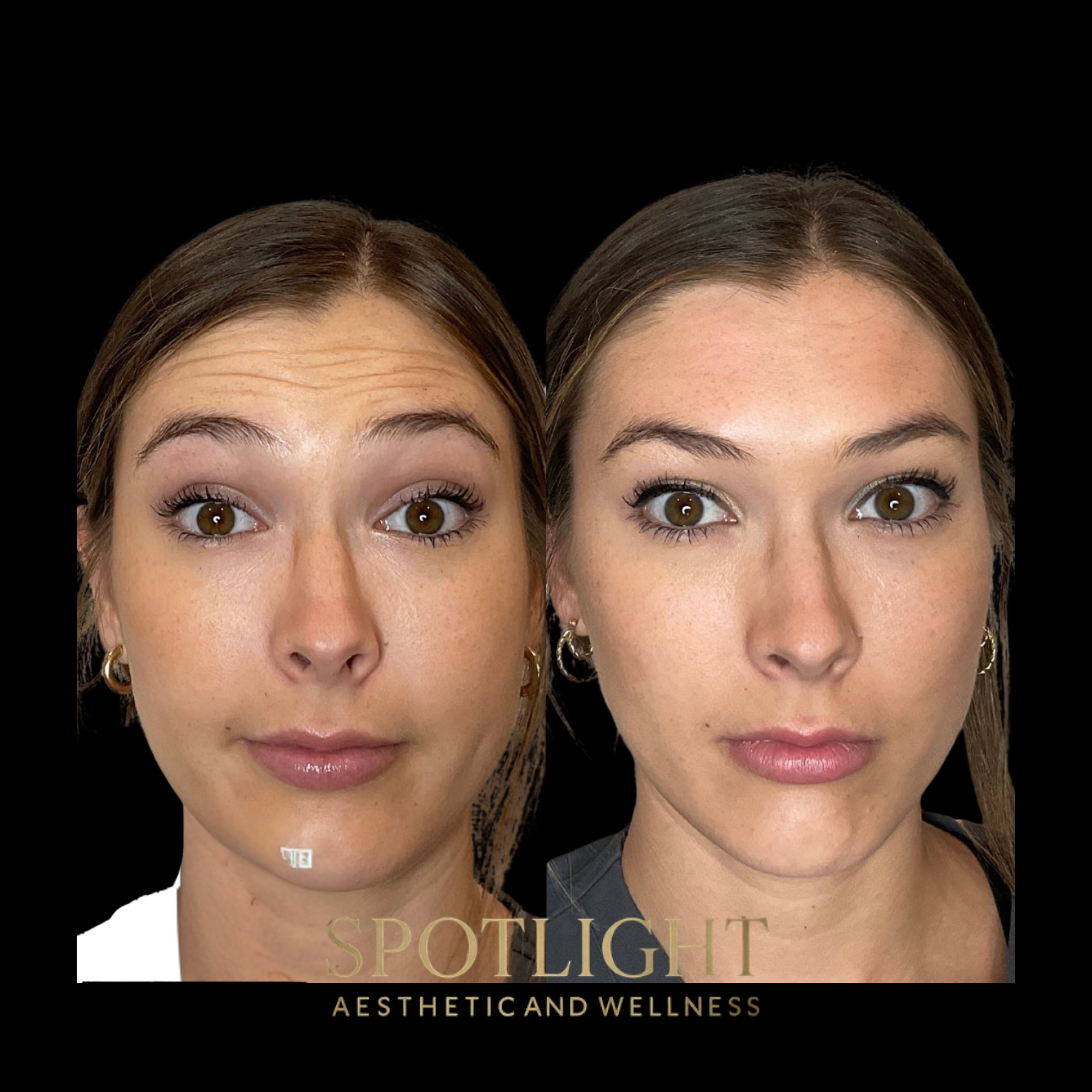 Forehead Line Treatment - Before and after aesthetic treatment results by Melissa Singleton PA-C