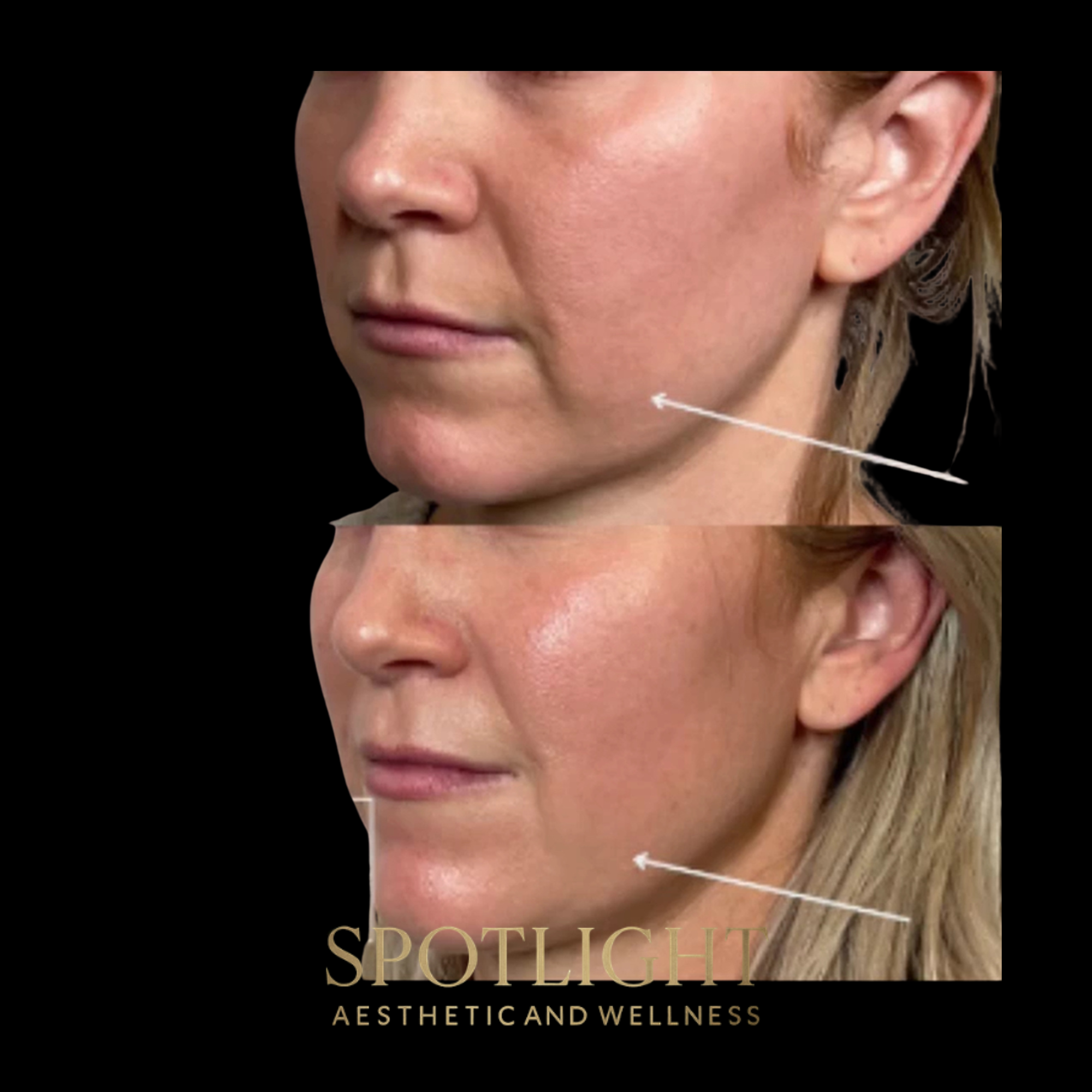 Jawline Contouring & Definition - Before and after aesthetic treatment results by Melissa Singleton PA-C