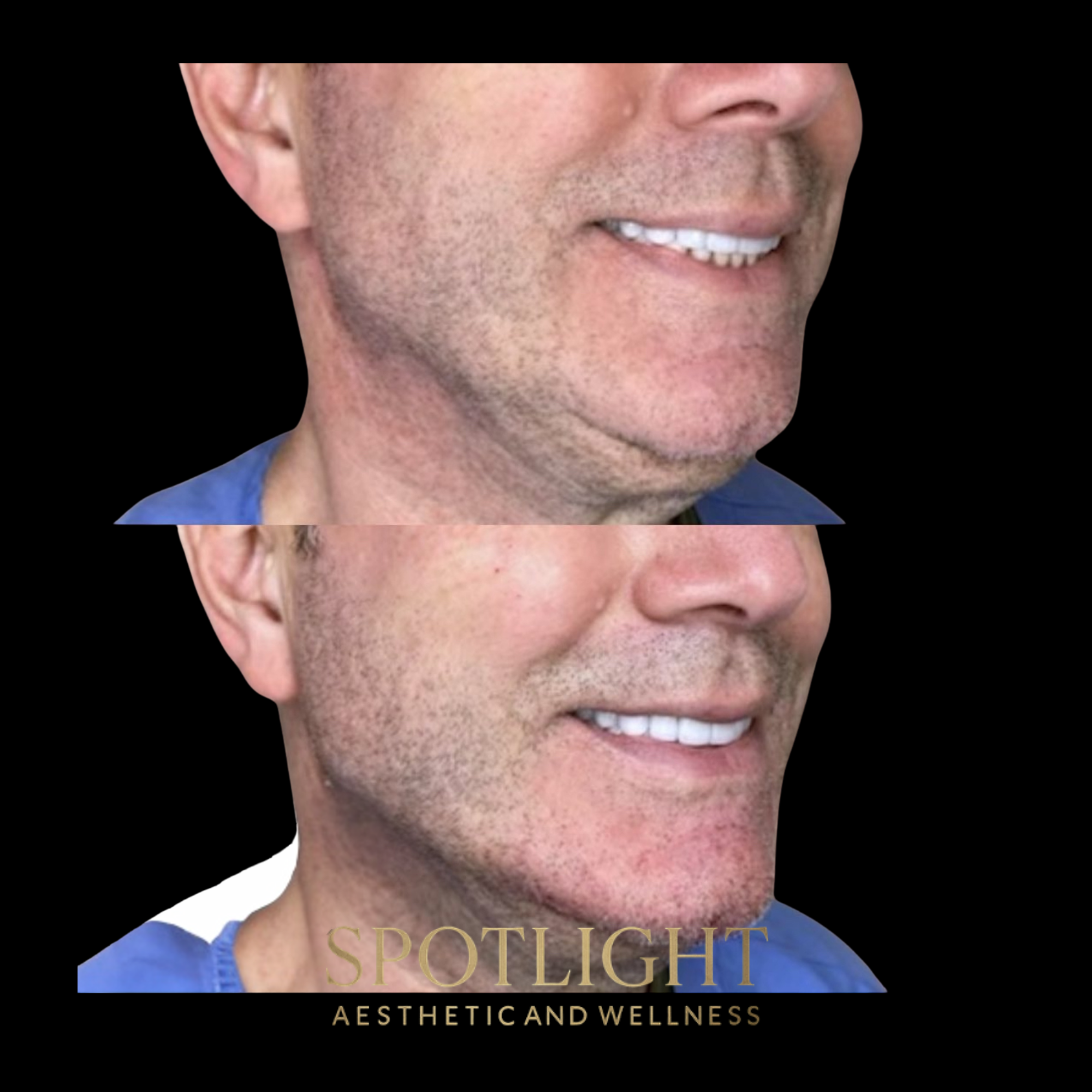 Jawline Contour Enhancement - Before and after aesthetic treatment results by Melissa Singleton PA-C