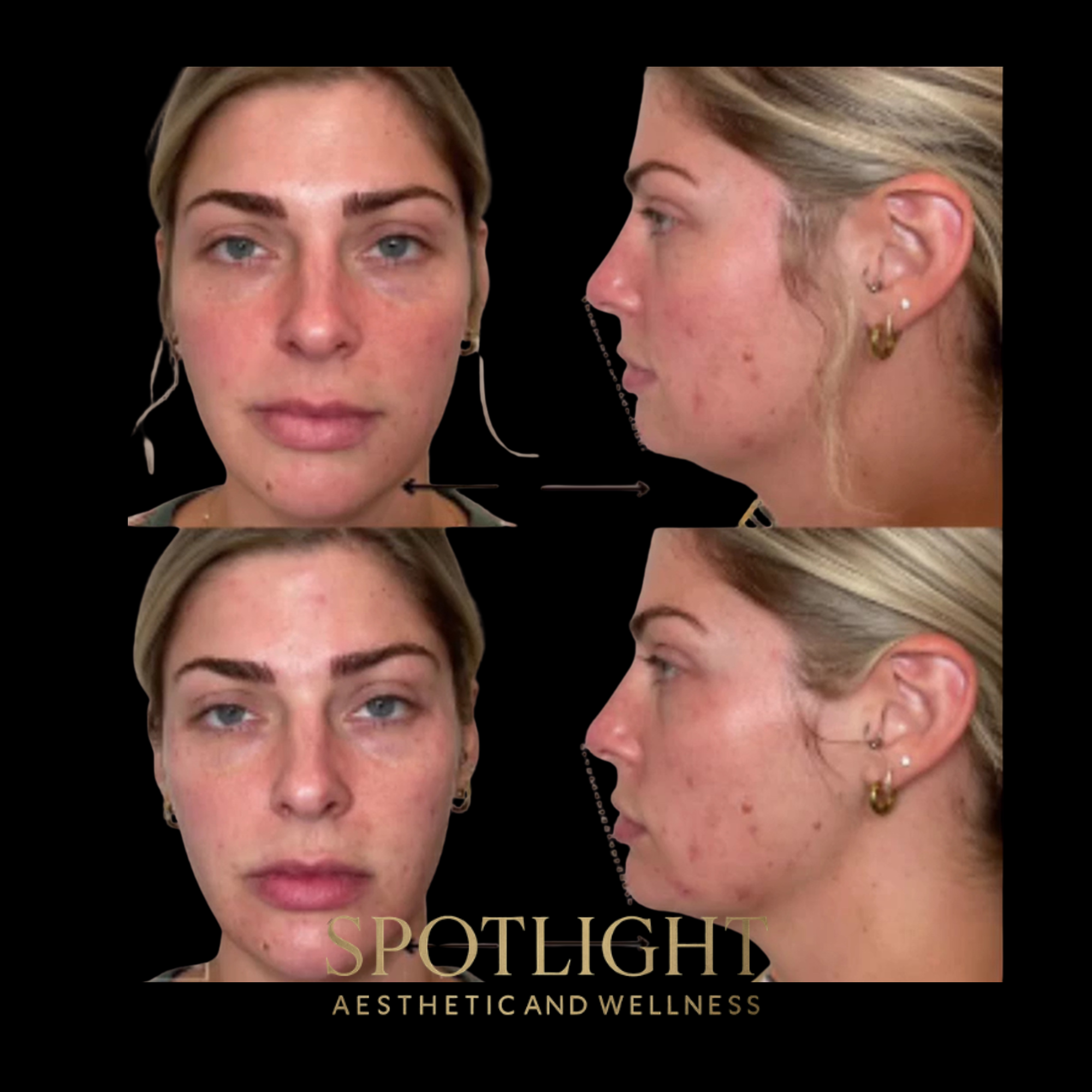 Multi-Angle Facial Rejuvenation - Before and after aesthetic treatment results by Melissa Singleton PA-C
