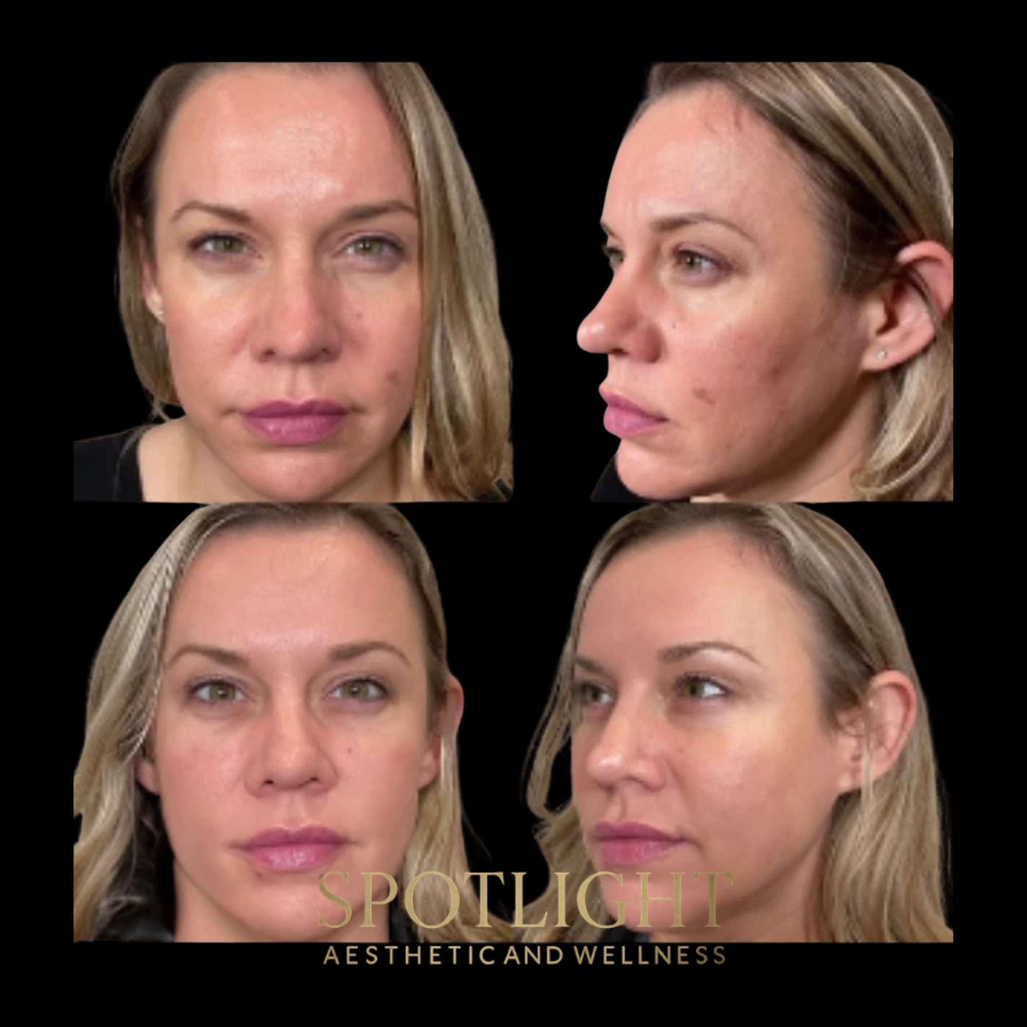 Complete Facial Enhancement - Before and after aesthetic treatment results by Melissa Singleton PA-C