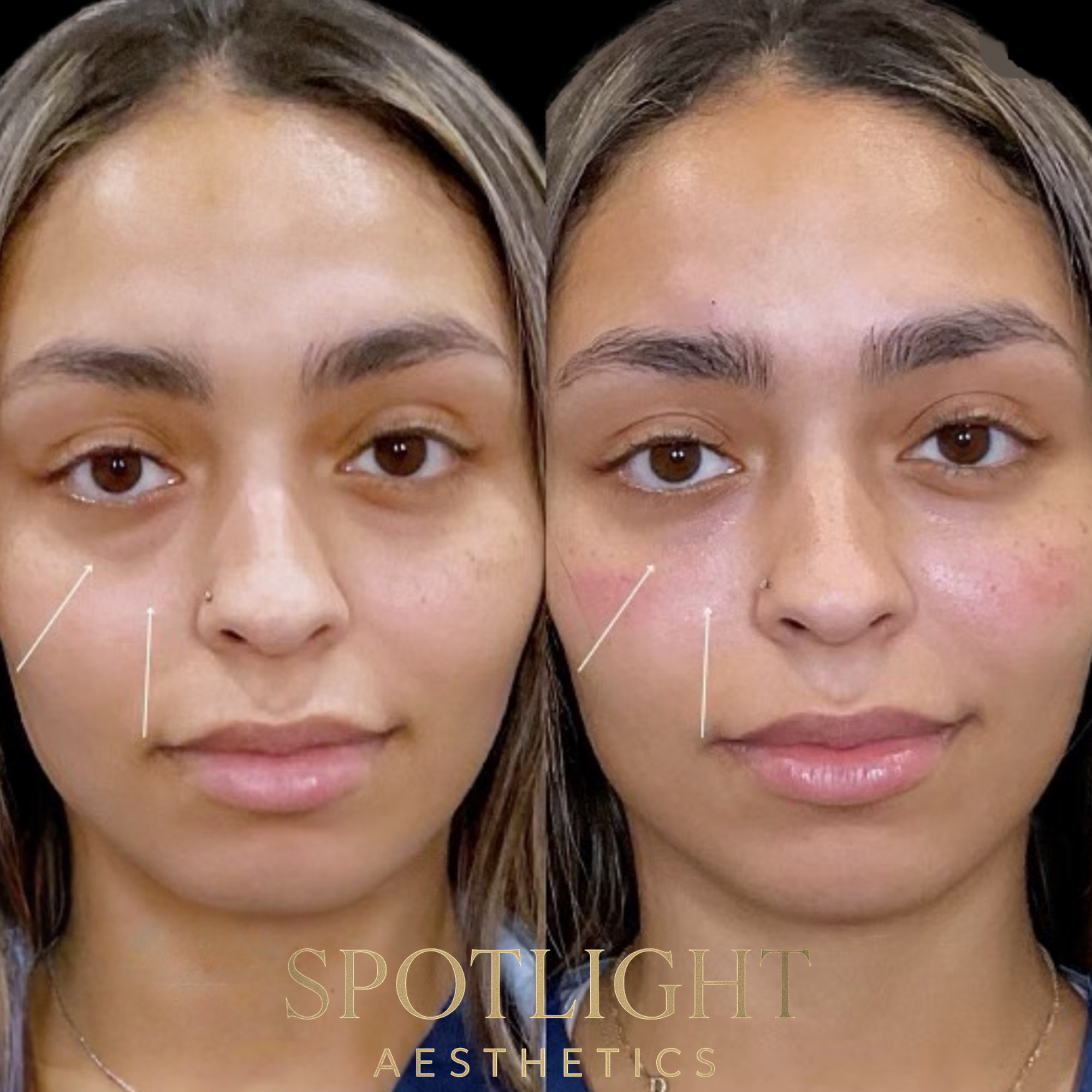 Cheek Contouring Enhancement - Before and after aesthetic treatment results by Melissa Singleton PA-C
