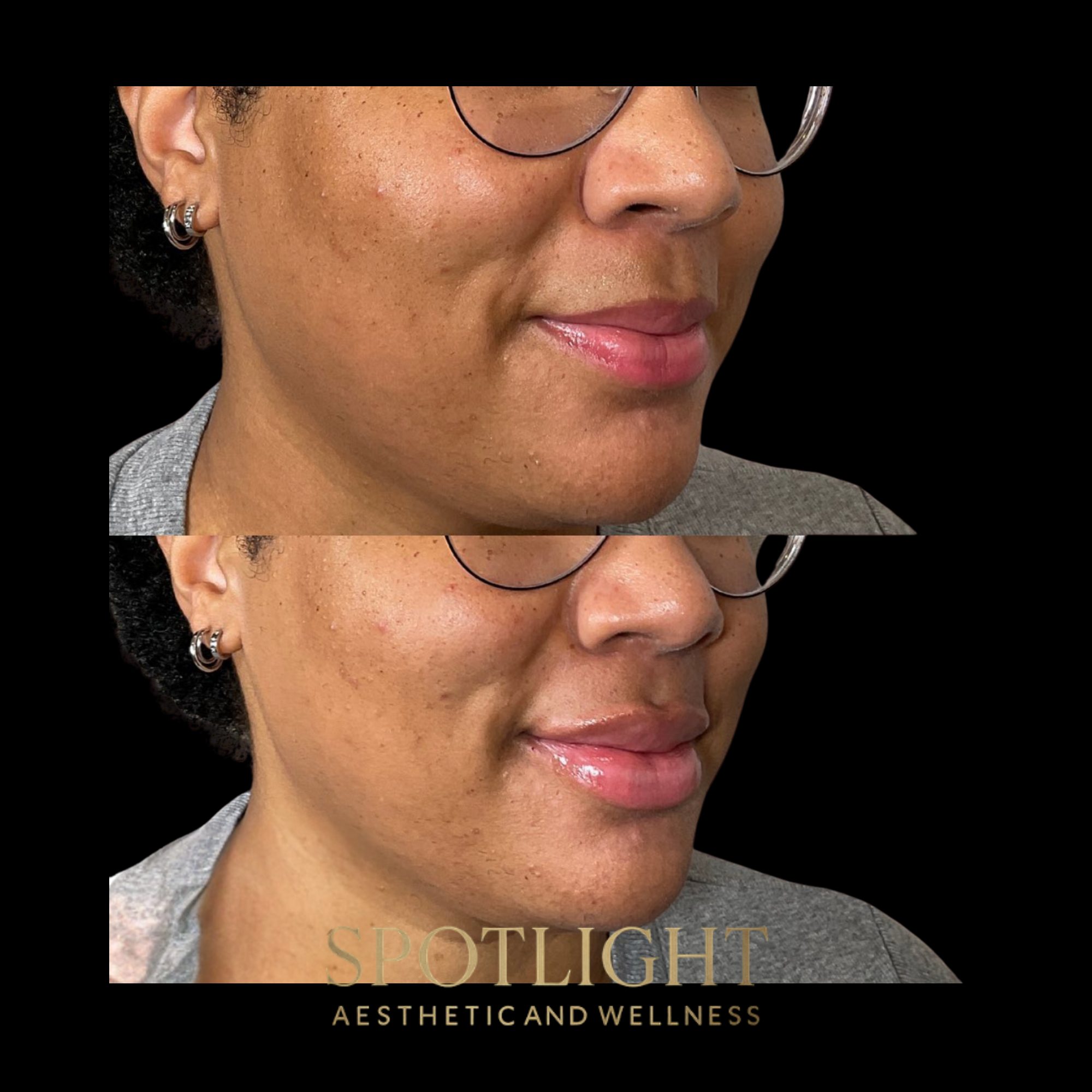 Marionette Line Correction - Before and after aesthetic treatment results by Melissa Singleton PA-C