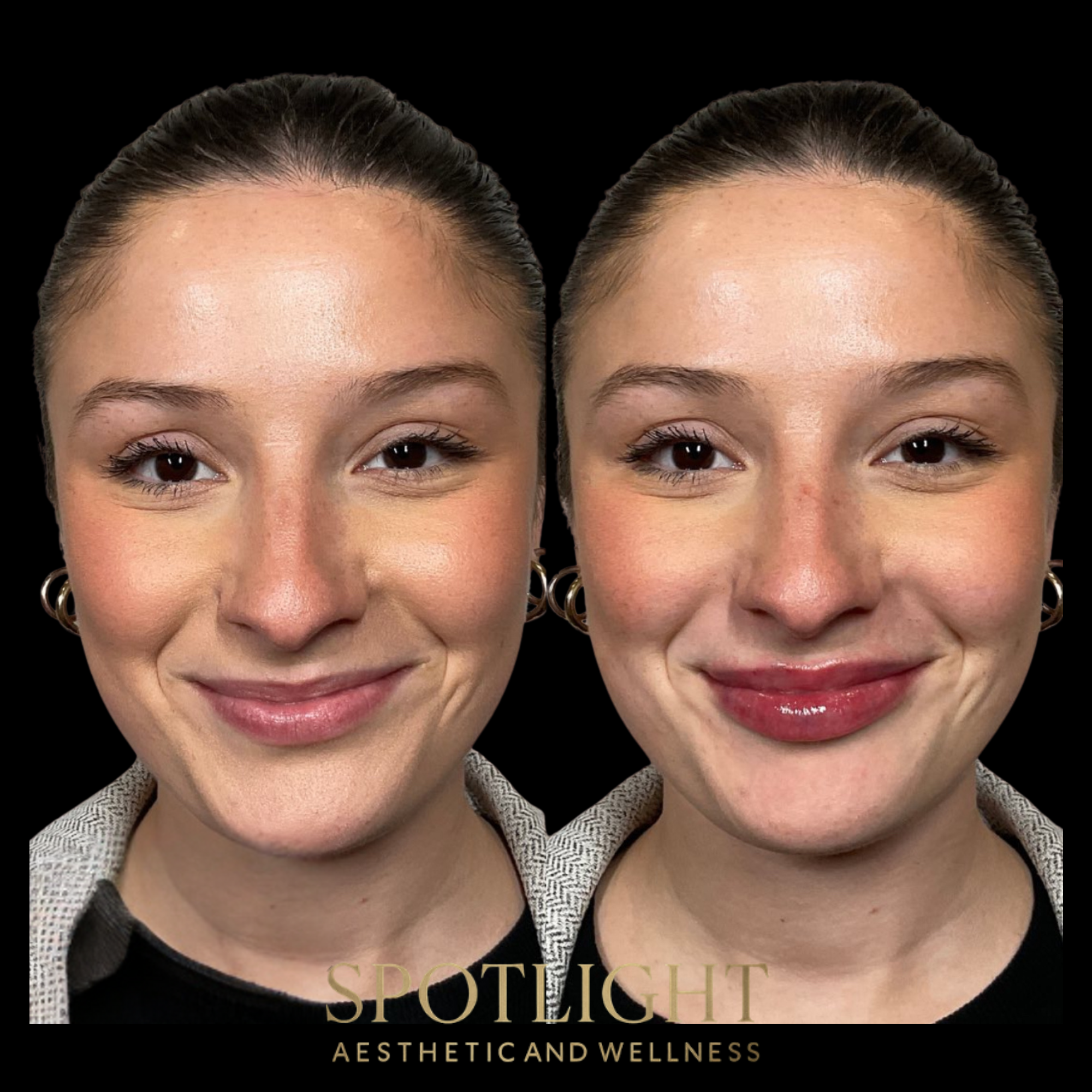 Tear Trough Rejuvenation - Before and after aesthetic treatment results by Melissa Singleton PA-C