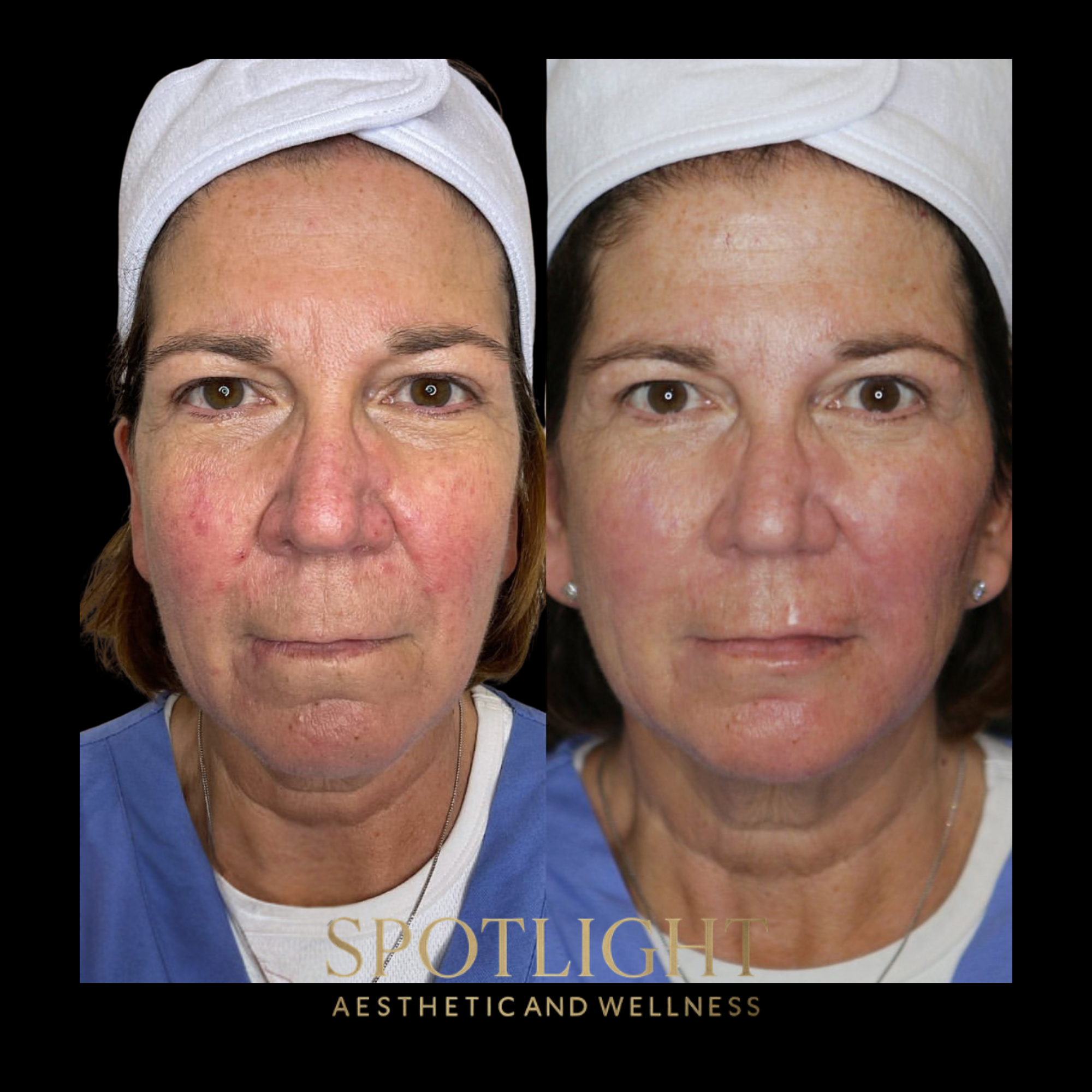 Comprehensive Facial Balancing - Before and after aesthetic treatment results by Melissa Singleton PA-C