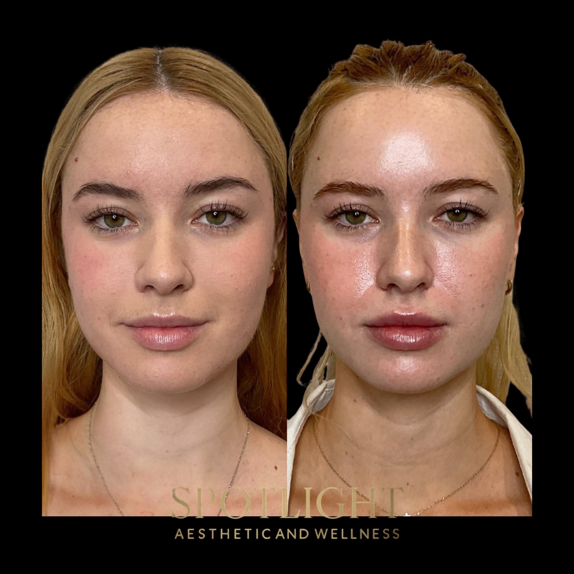 Natural Cheek Enhancement - Before and after aesthetic treatment results by Melissa Singleton PA-C