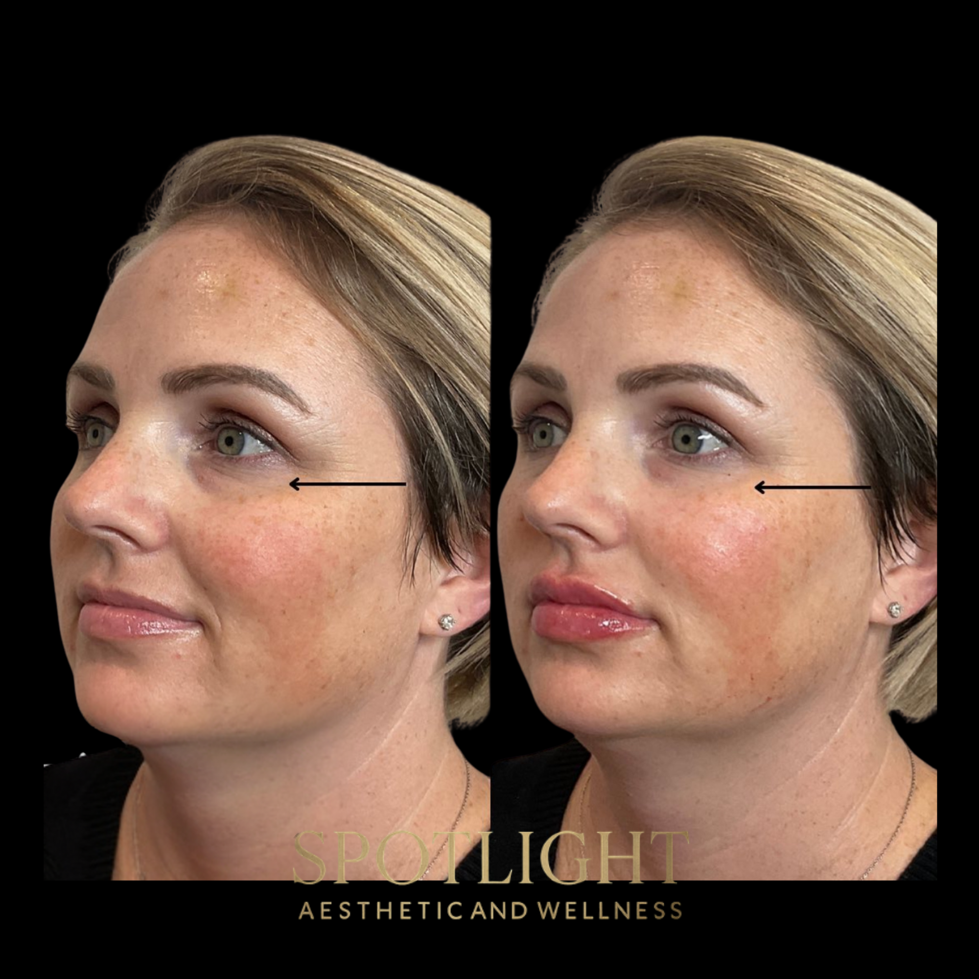 Cheek & Tear Trough Combination - Before and after aesthetic treatment results by Melissa Singleton PA-C