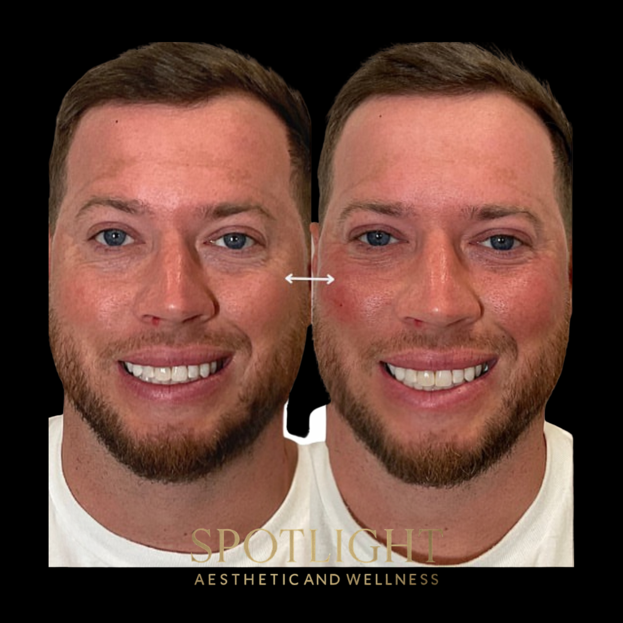 Under-Eye Rejuvenation - Before and after aesthetic treatment results by Melissa Singleton PA-C