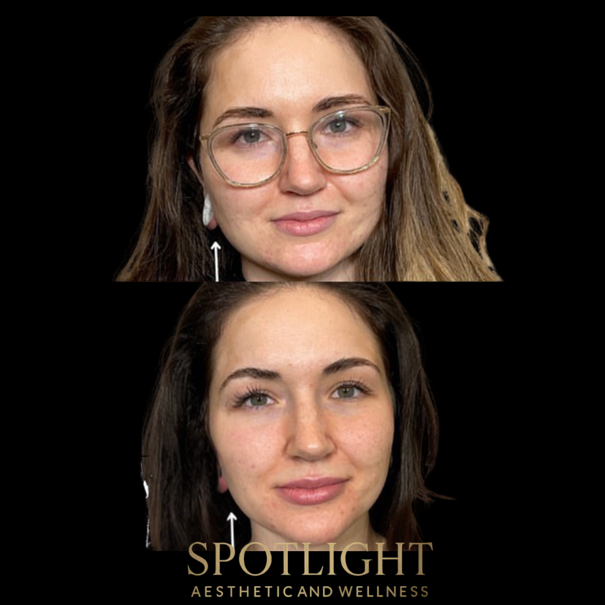 Youthful Cheek Enhancement - Before and after aesthetic treatment results by Melissa Singleton PA-C