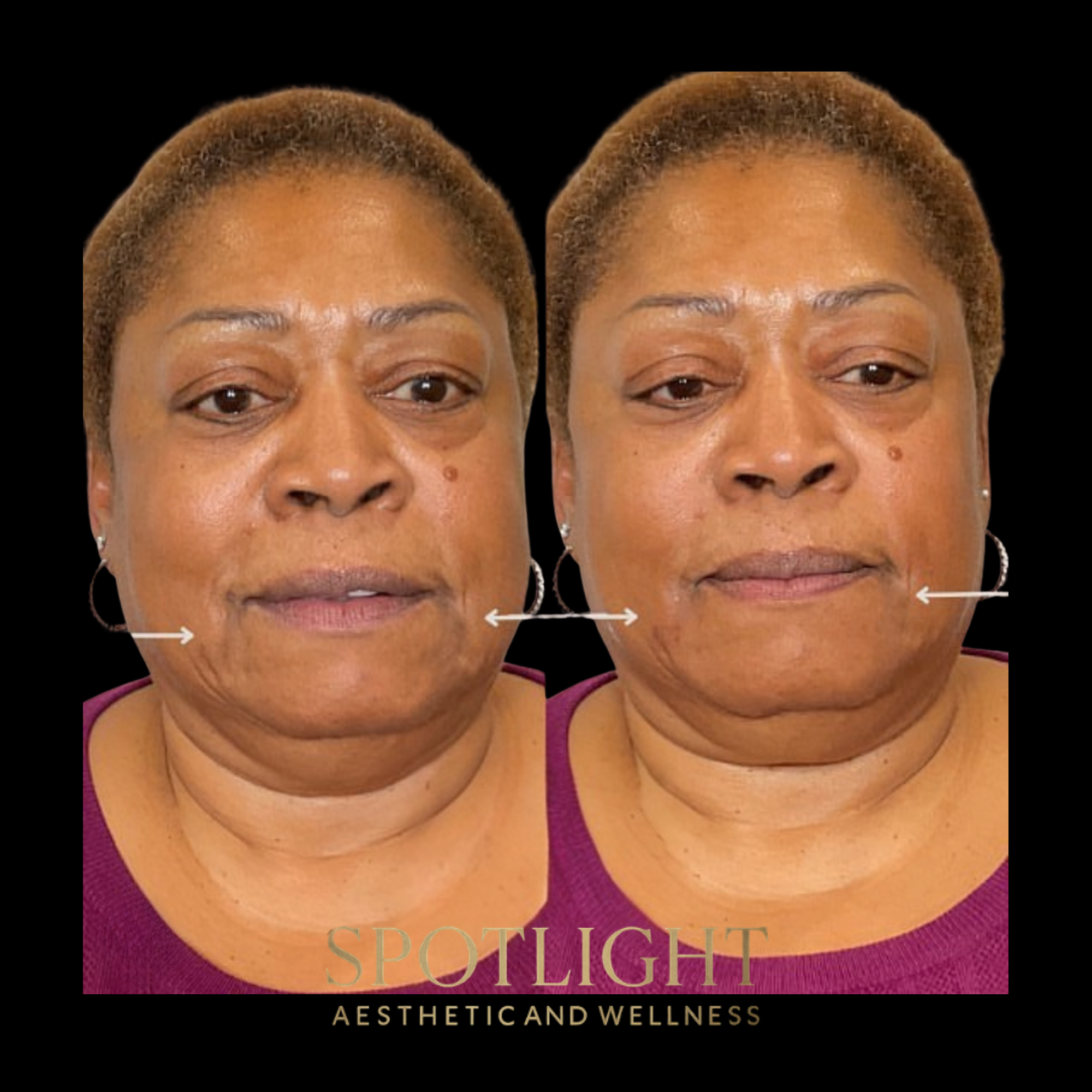 Marionette Line Treatment - Before and after aesthetic treatment results by Melissa Singleton PA-C