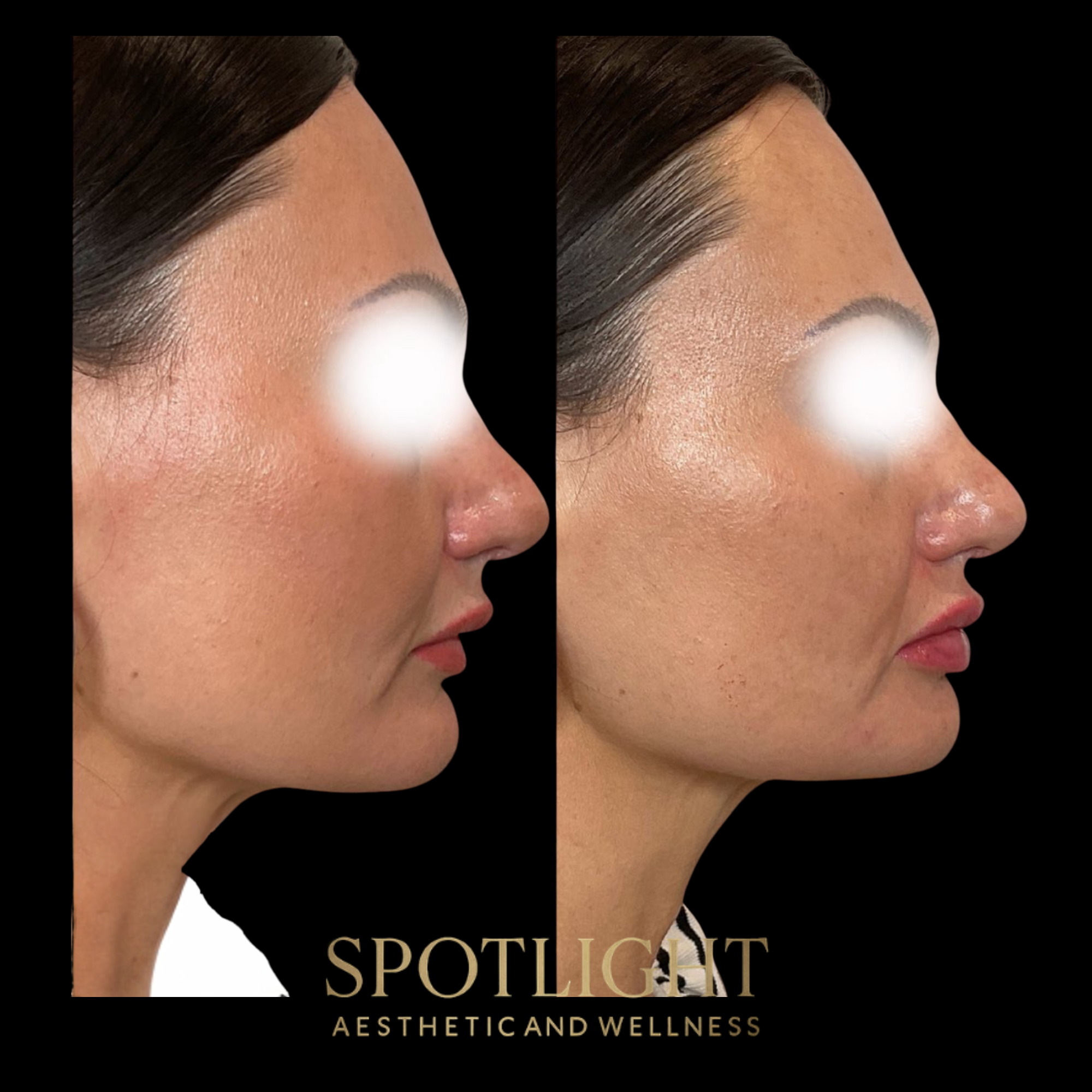 Profile Enhancement - Before and after aesthetic treatment results by Melissa Singleton PA-C