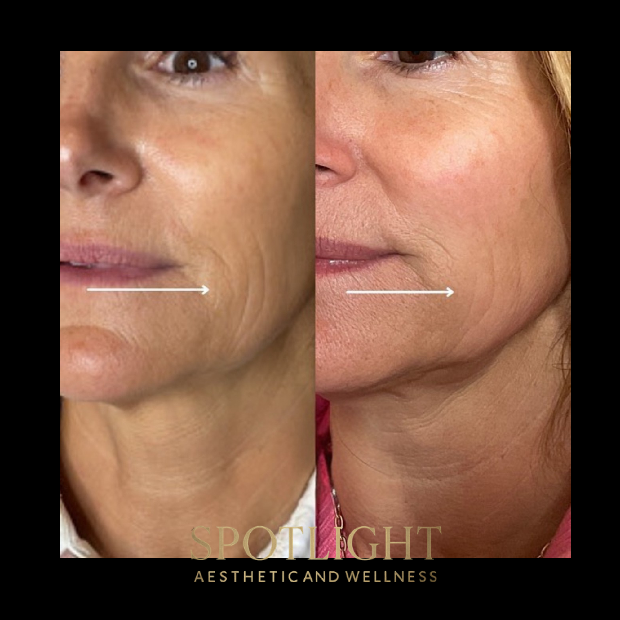 Sculptra Smile Lines - Before and after aesthetic treatment results by Melissa Singleton PA-C