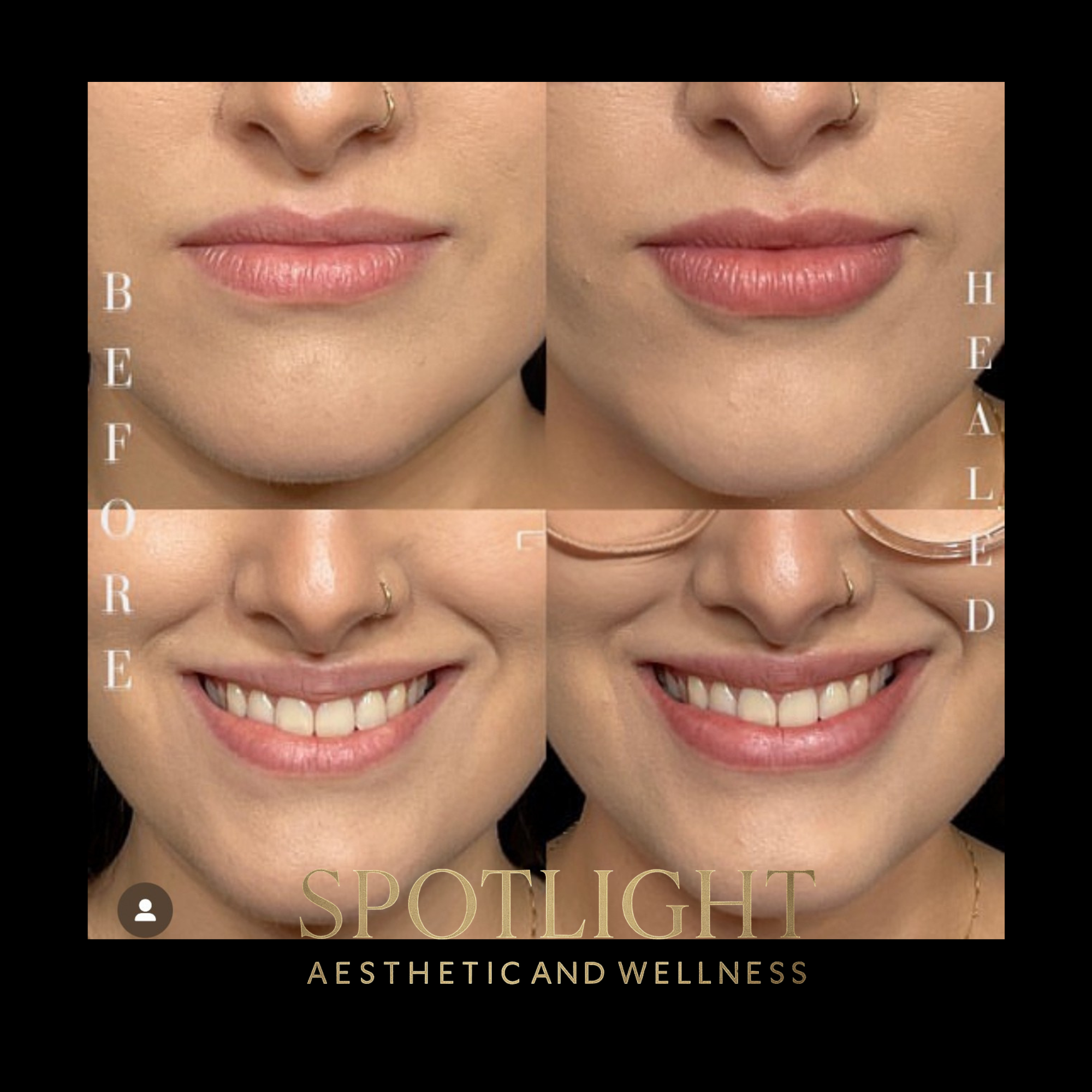 Natural Lip Enhancement - Before and after aesthetic treatment results by Melissa Singleton PA-C