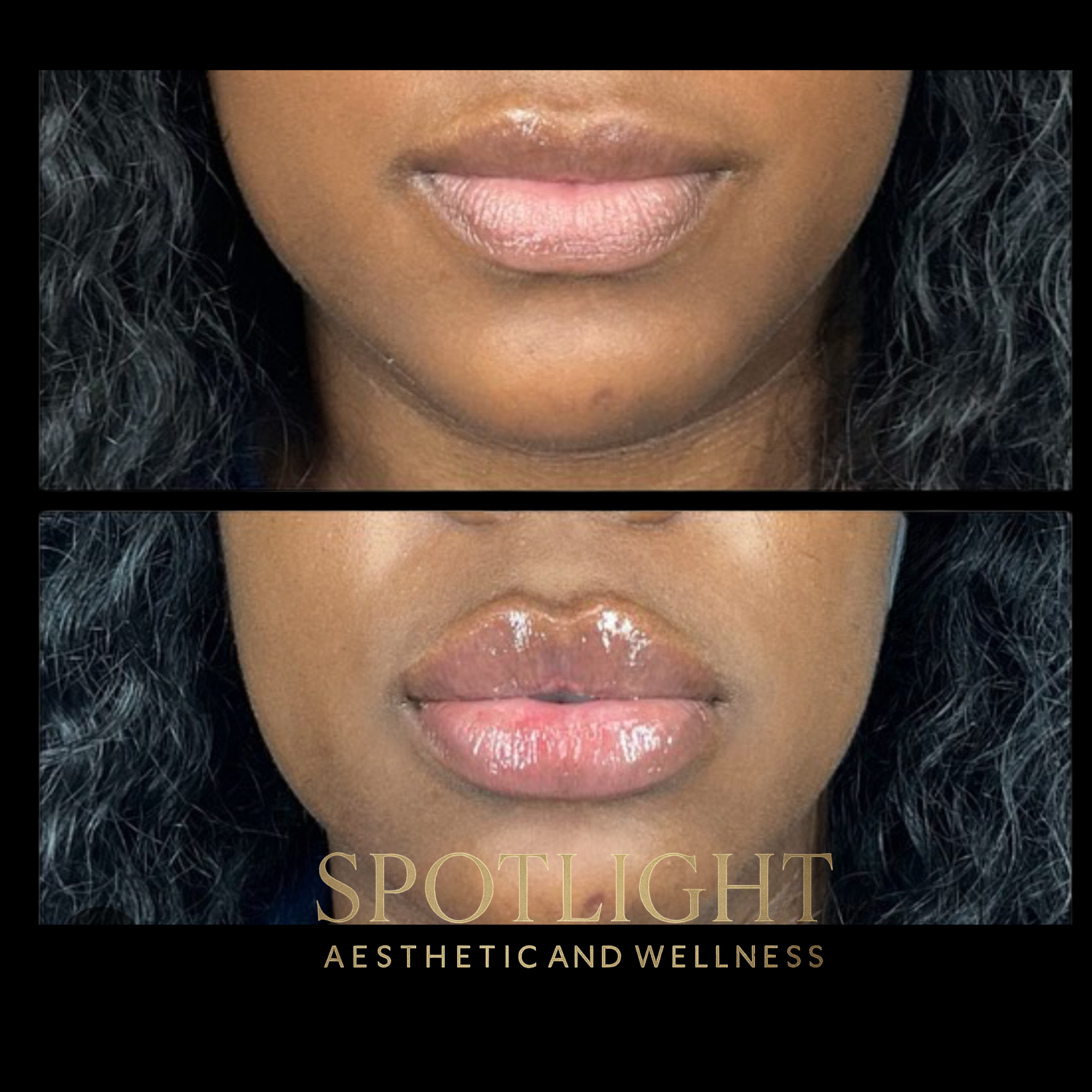 Natural Lip Augmentation - Before and after aesthetic treatment results by Melissa Singleton PA-C