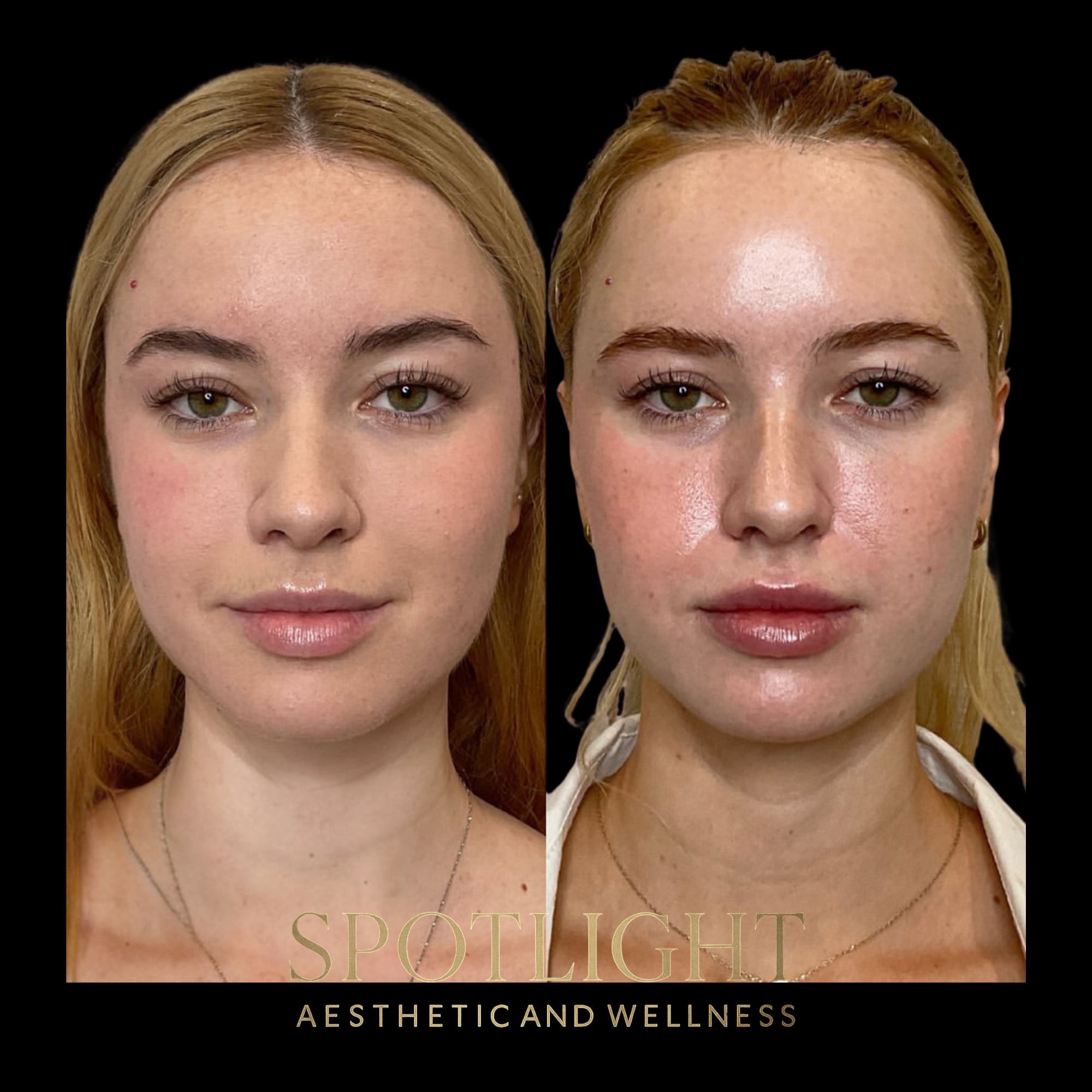 Elegant Lip Enhancement - Before and after aesthetic treatment results by Melissa Singleton PA-C