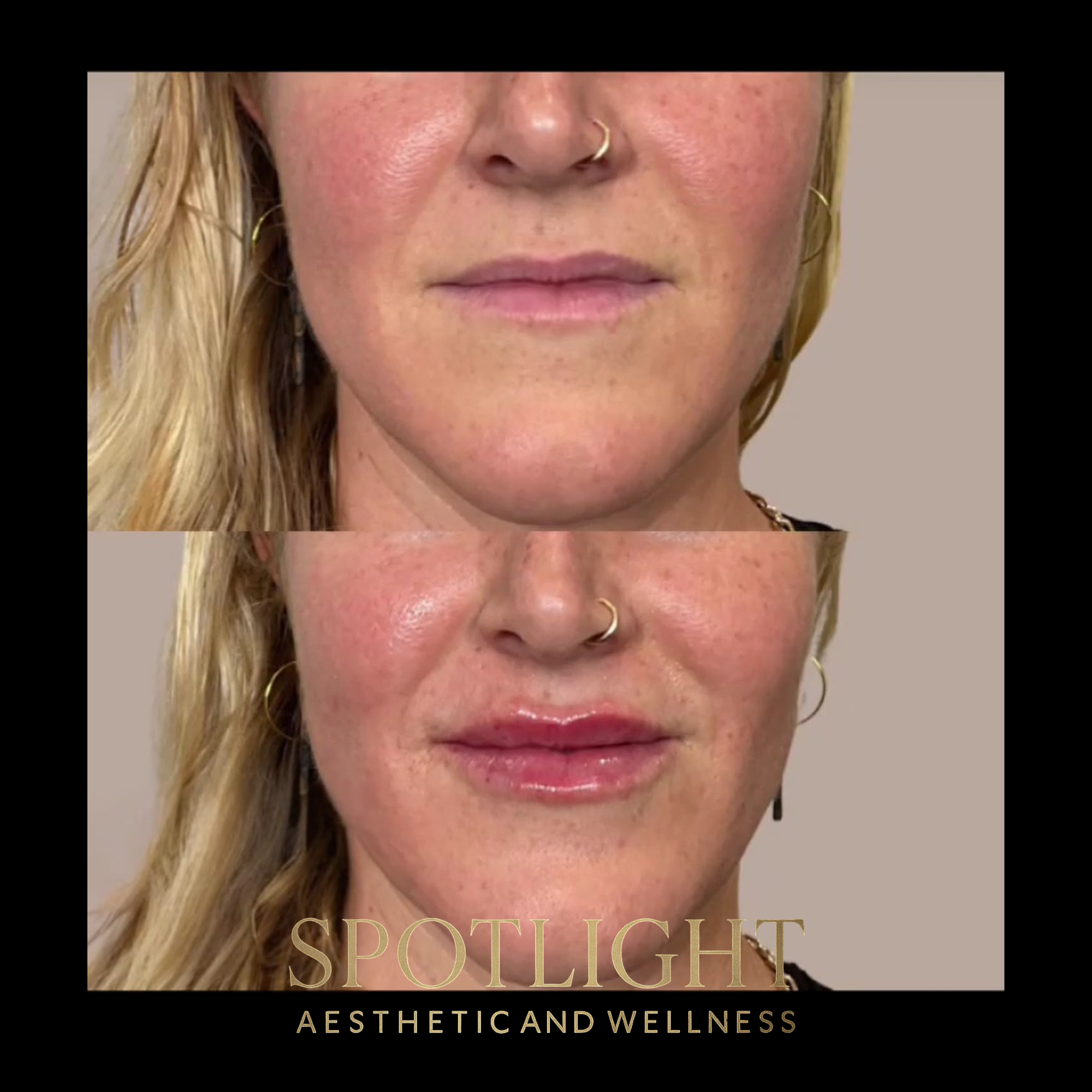 Dramatic Lip Transformation - Before and after aesthetic treatment results by Melissa Singleton PA-C