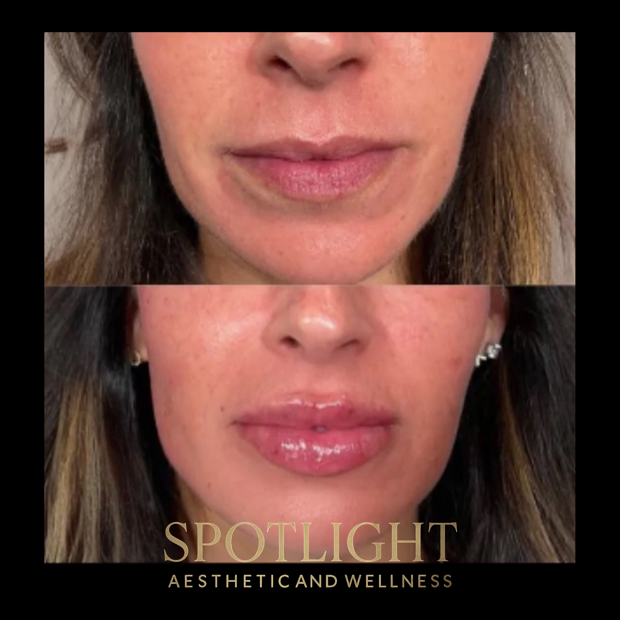 Glossy Lip Enhancement - Before and after aesthetic treatment results by Melissa Singleton PA-C