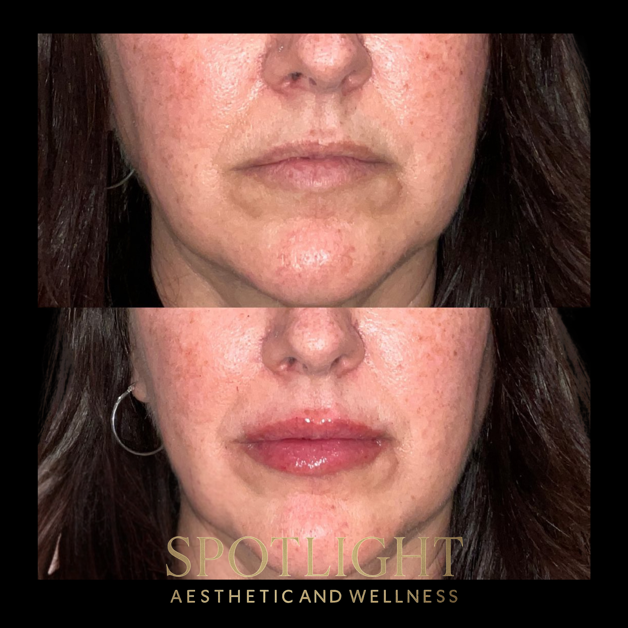 Lip Volume Restoration - Before and after aesthetic treatment results by Melissa Singleton PA-C