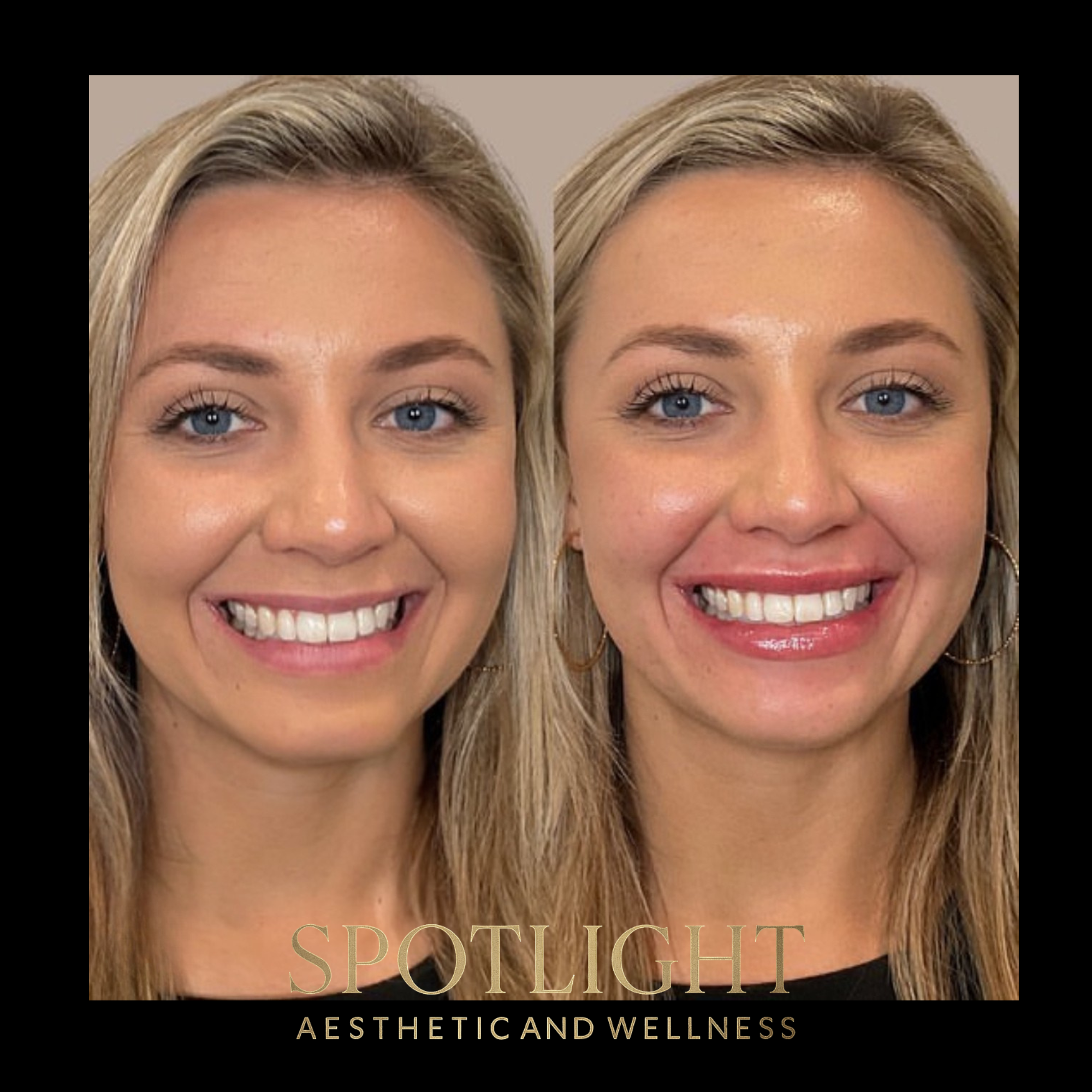 Complete Smile Enhancement - Before and after aesthetic treatment results by Melissa Singleton PA-C
