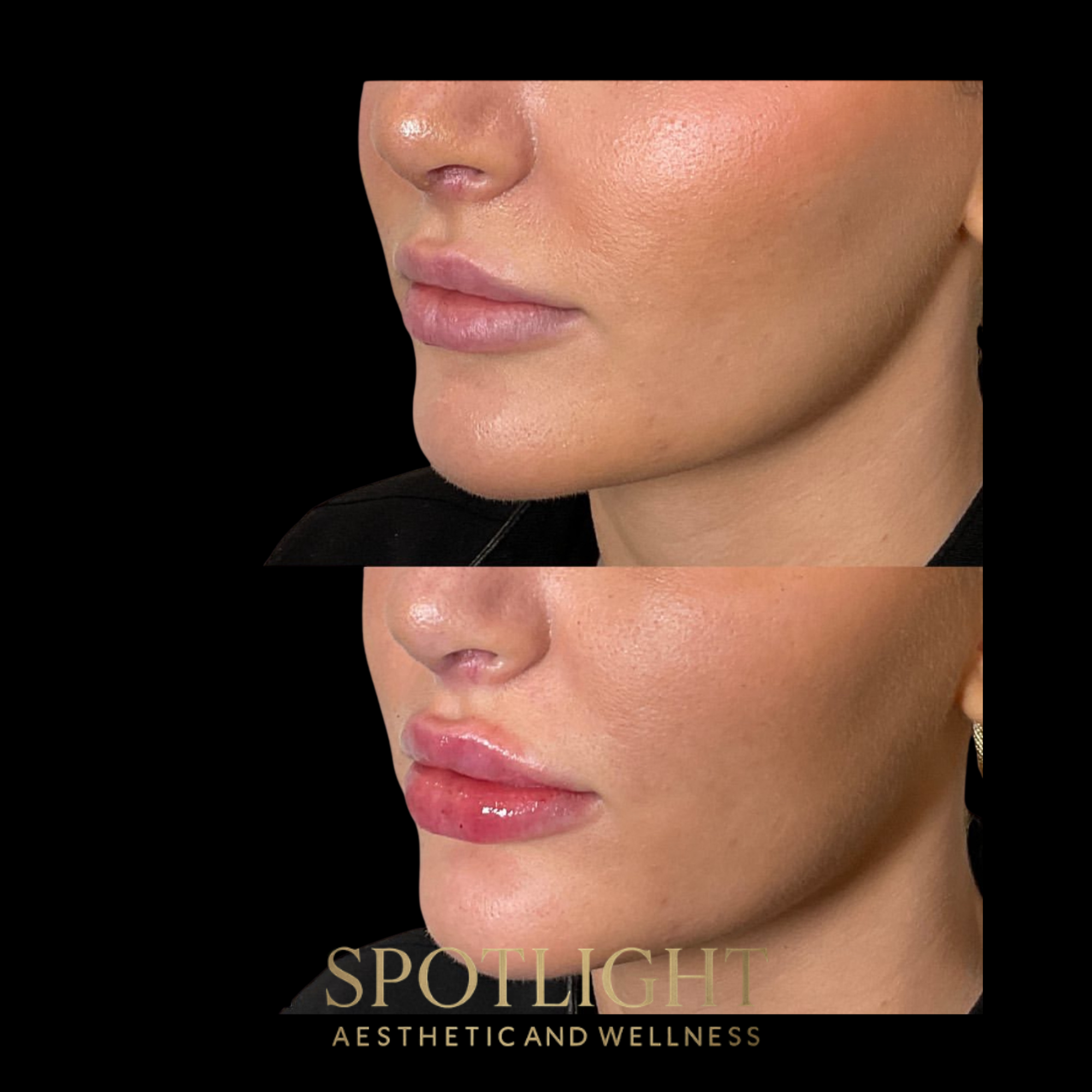 Natural Lip Volume Enhancement - Before and after aesthetic treatment results by Melissa Singleton PA-C