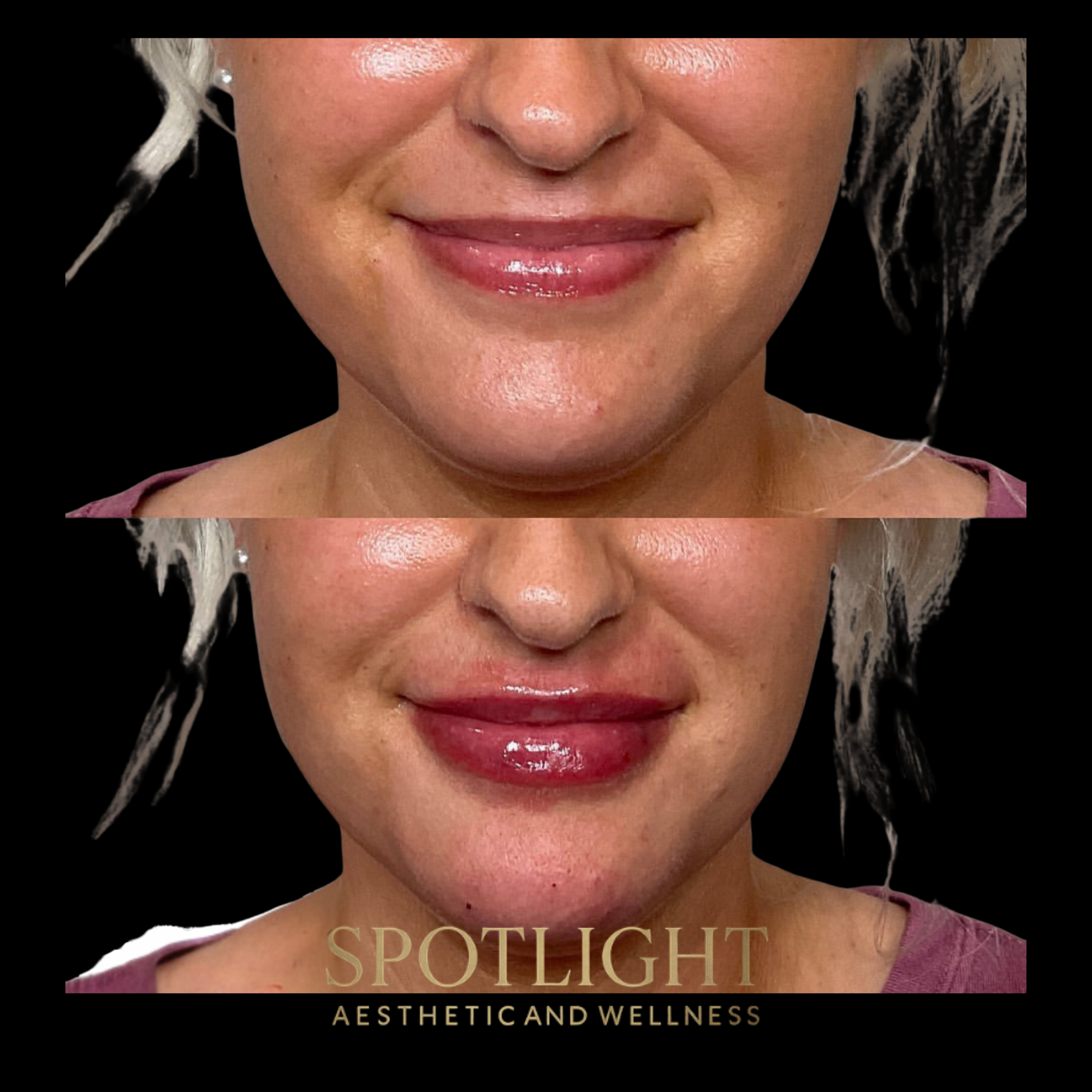 Lip Enhancement & Definition - Before and after aesthetic treatment results by Melissa Singleton PA-C