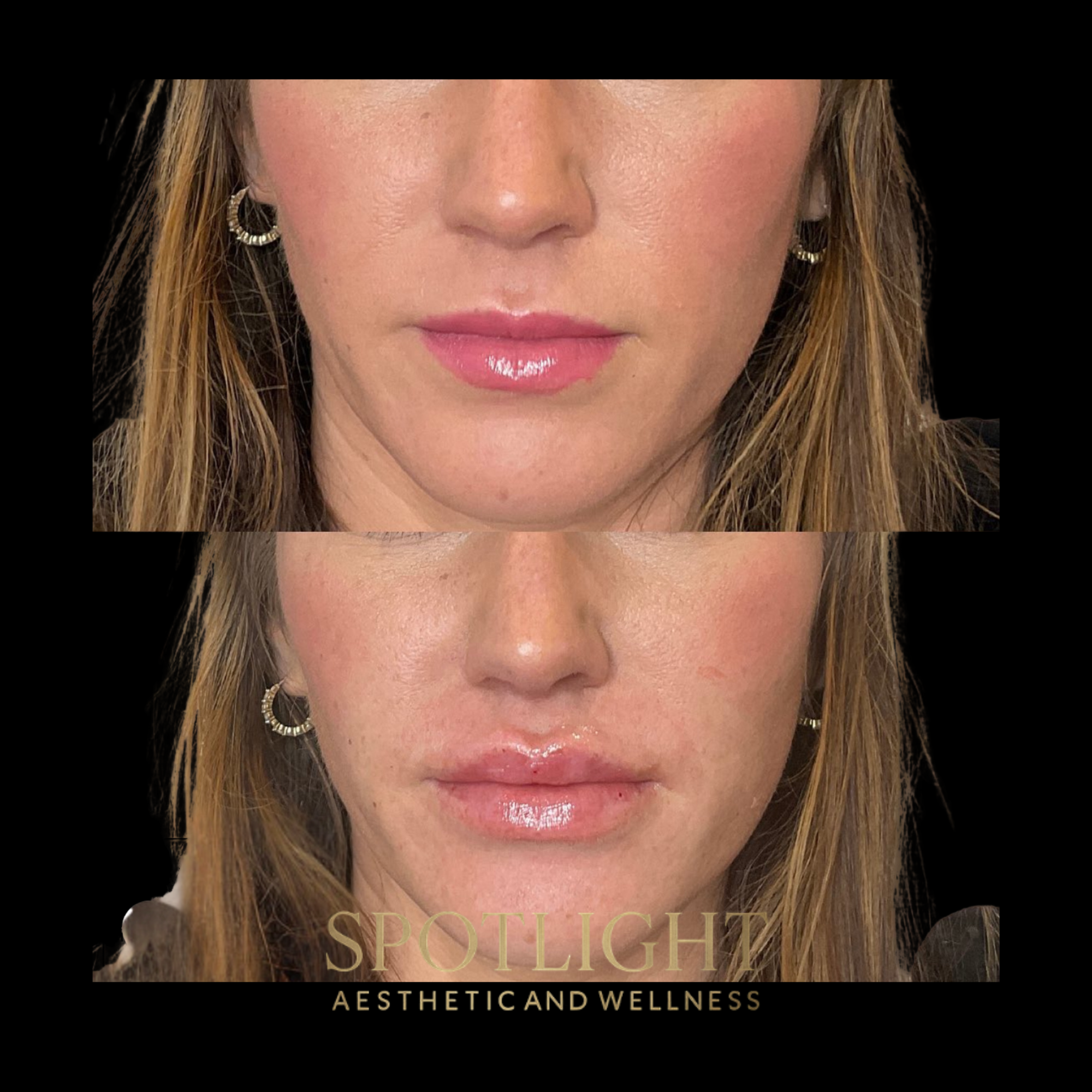Lip Volume Restoration - Before and after aesthetic treatment results by Melissa Singleton PA-C