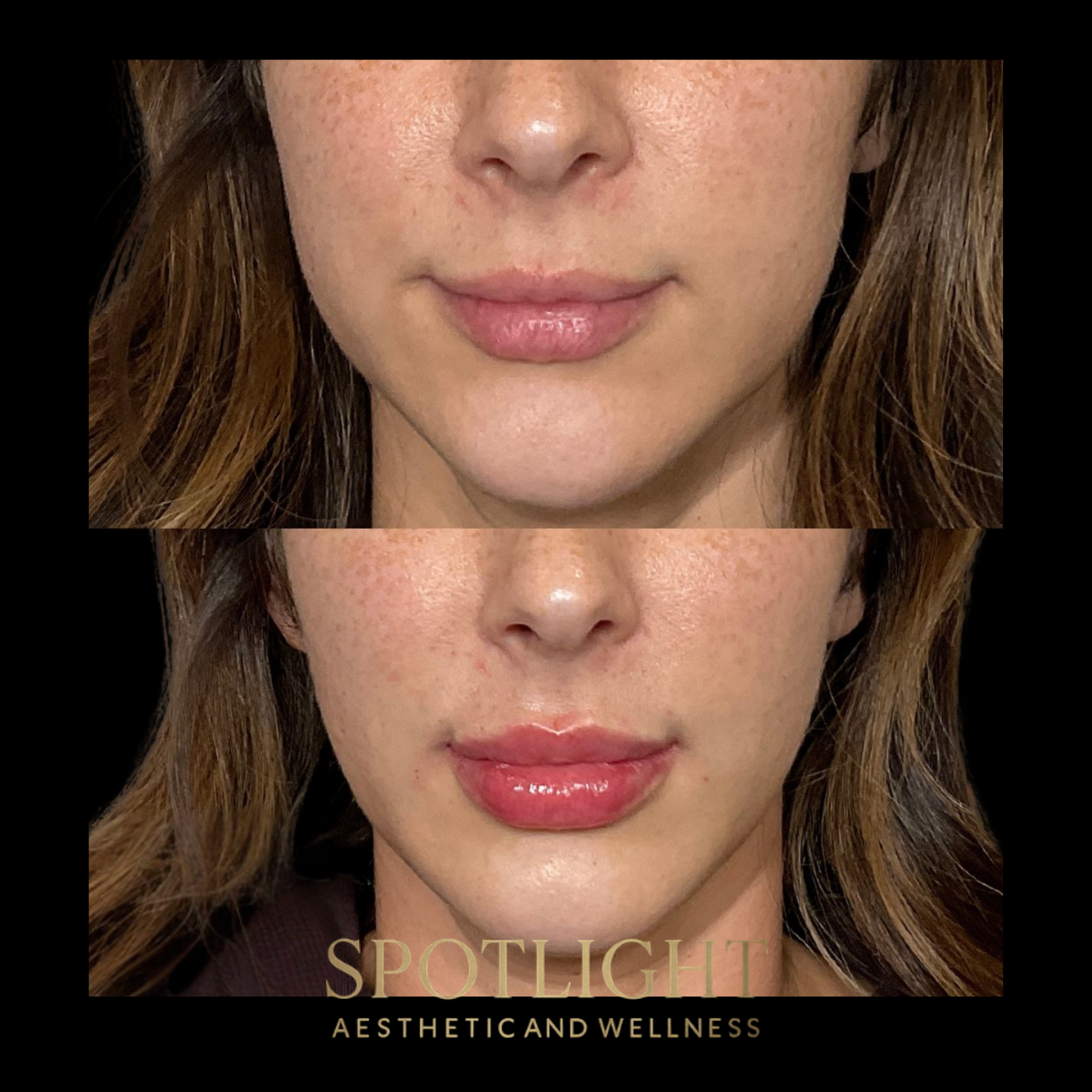 Lip Augmentation - Before and after aesthetic treatment results by Melissa Singleton PA-C