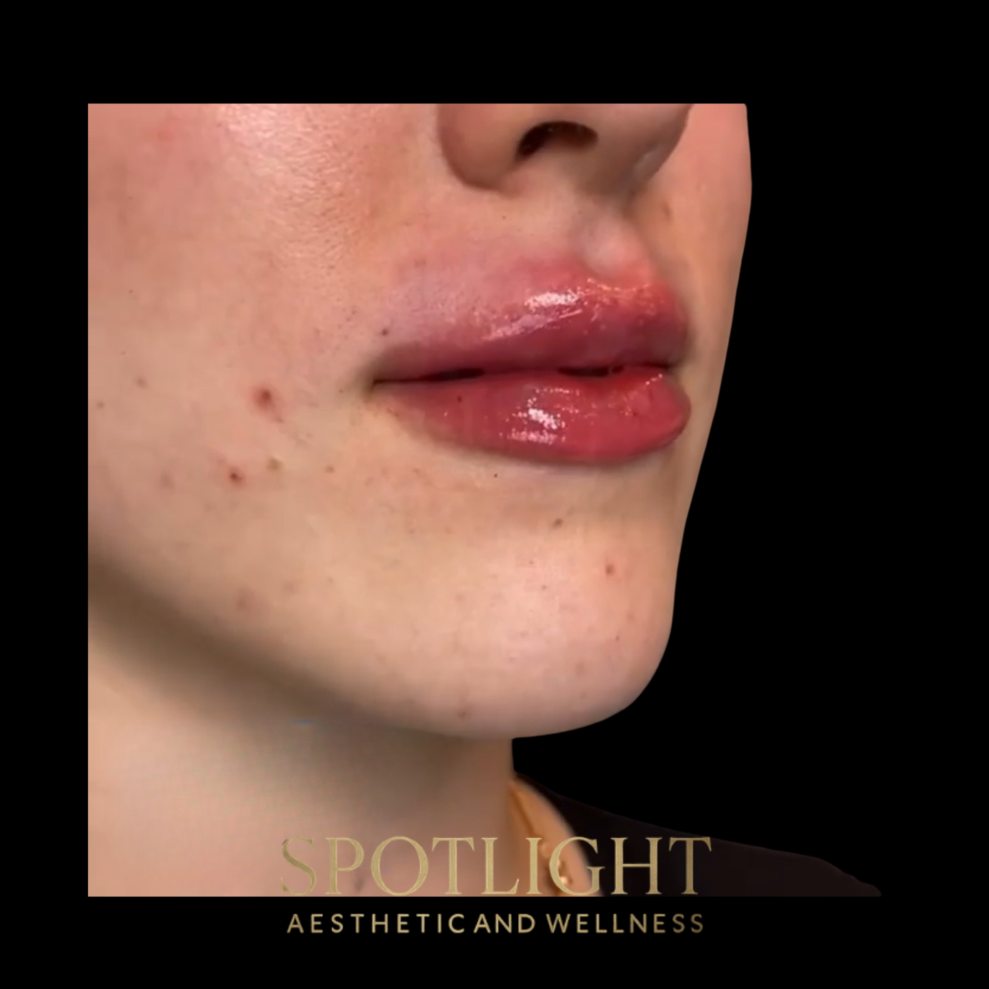 Lip Volume & Definition - Before and after aesthetic treatment results by Melissa Singleton PA-C