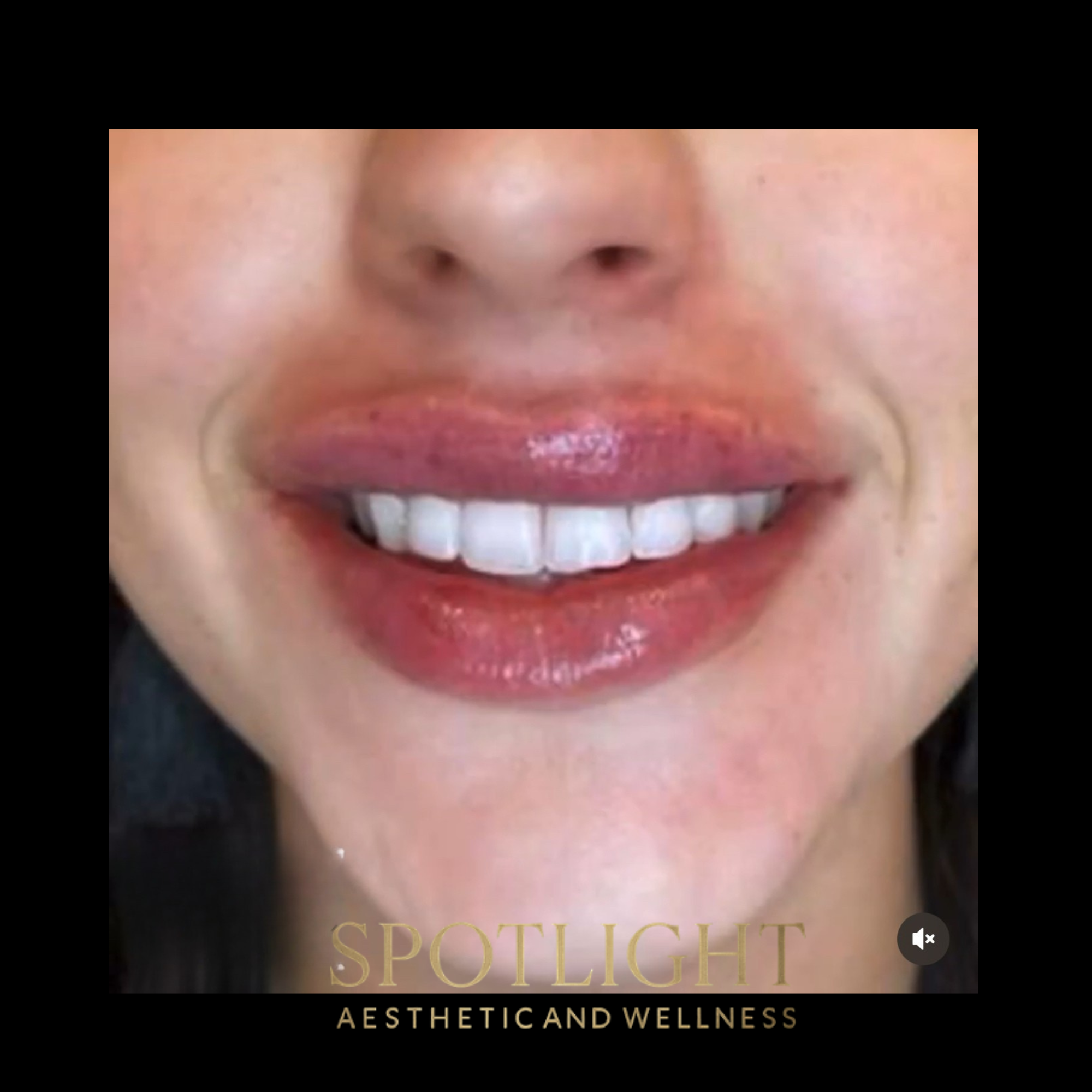 Smile Enhancement - Before and after aesthetic treatment results by Melissa Singleton PA-C