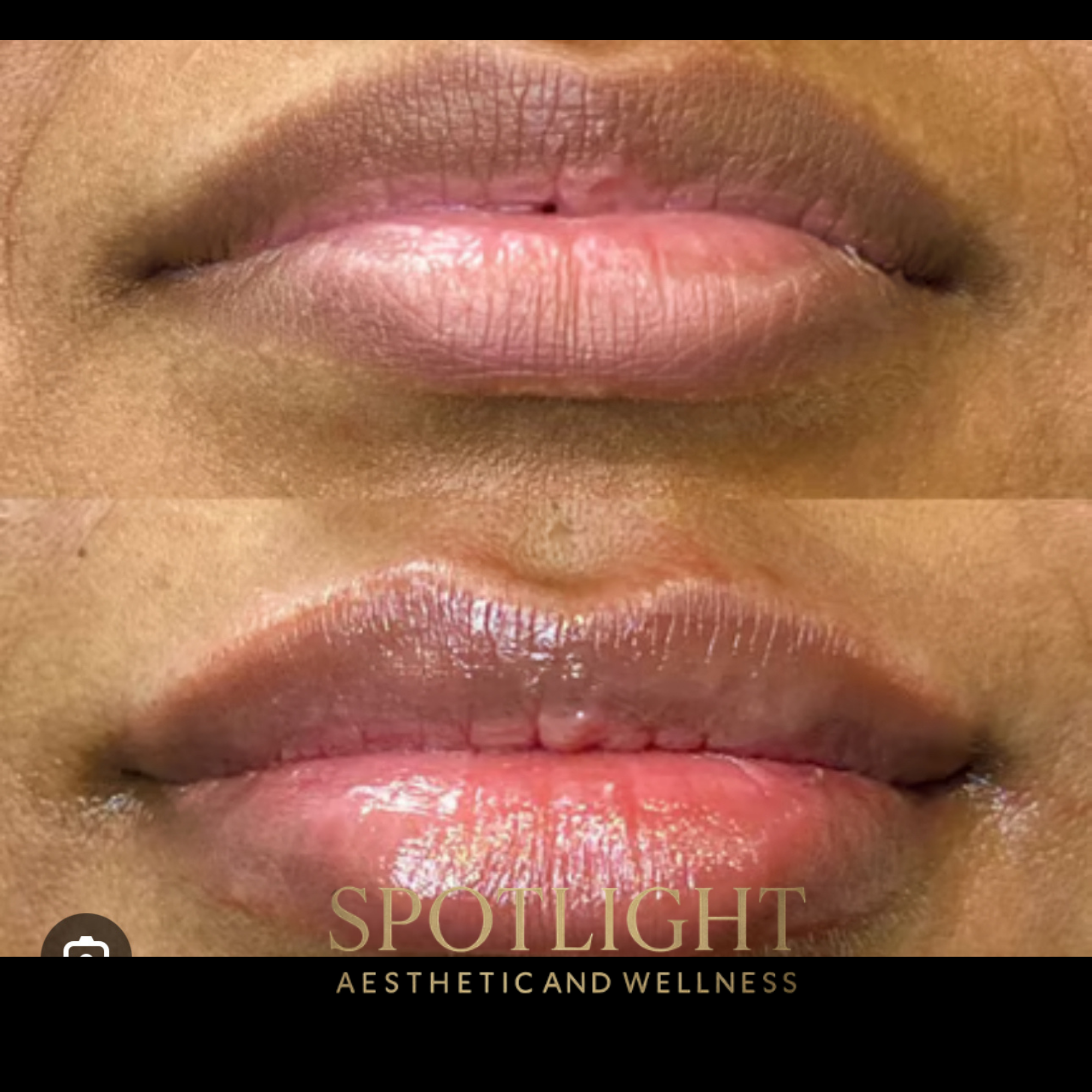 Lip Transformation - Before and after aesthetic treatment results by Melissa Singleton PA-C
