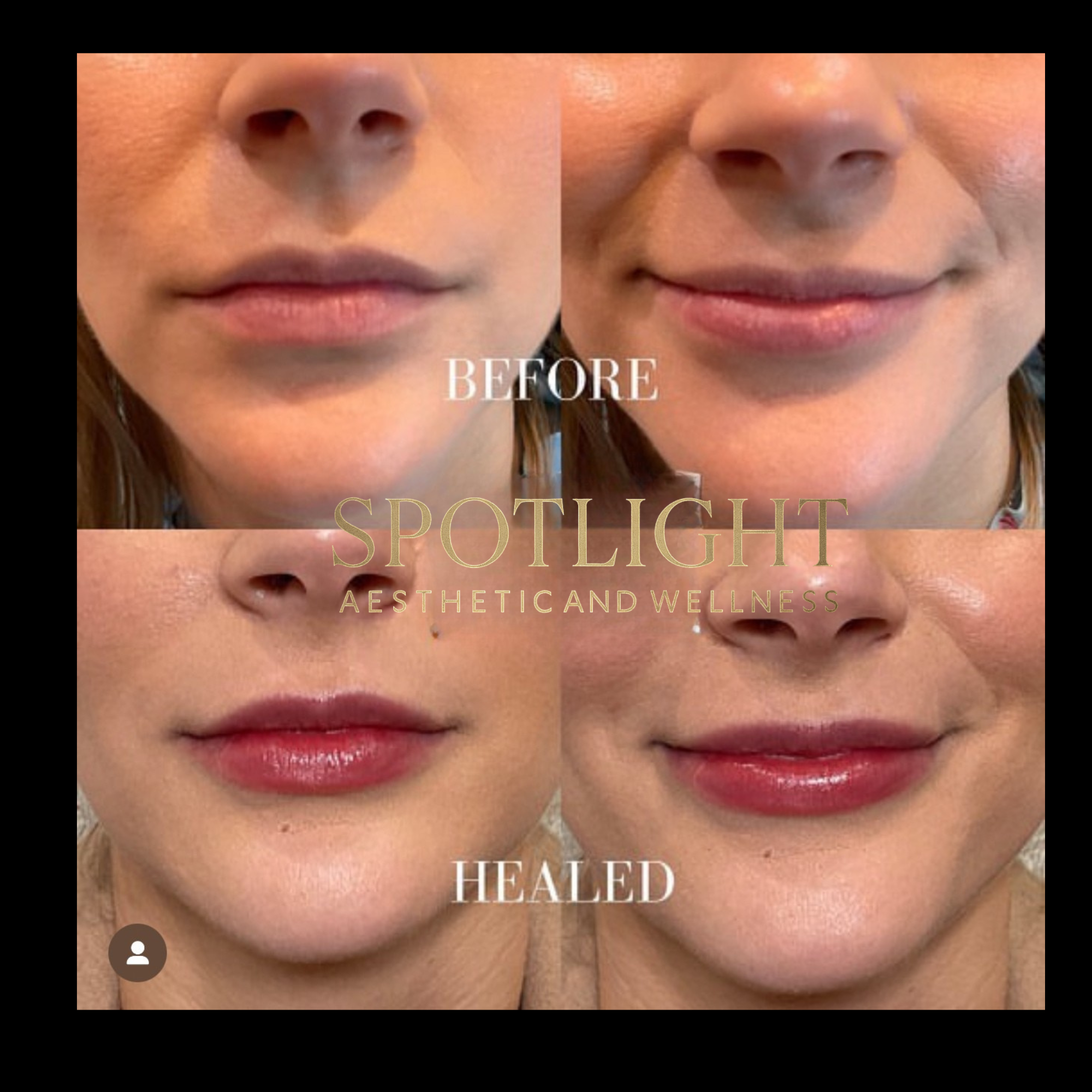Healed Lip Results - Before and after aesthetic treatment results by Melissa Singleton PA-C