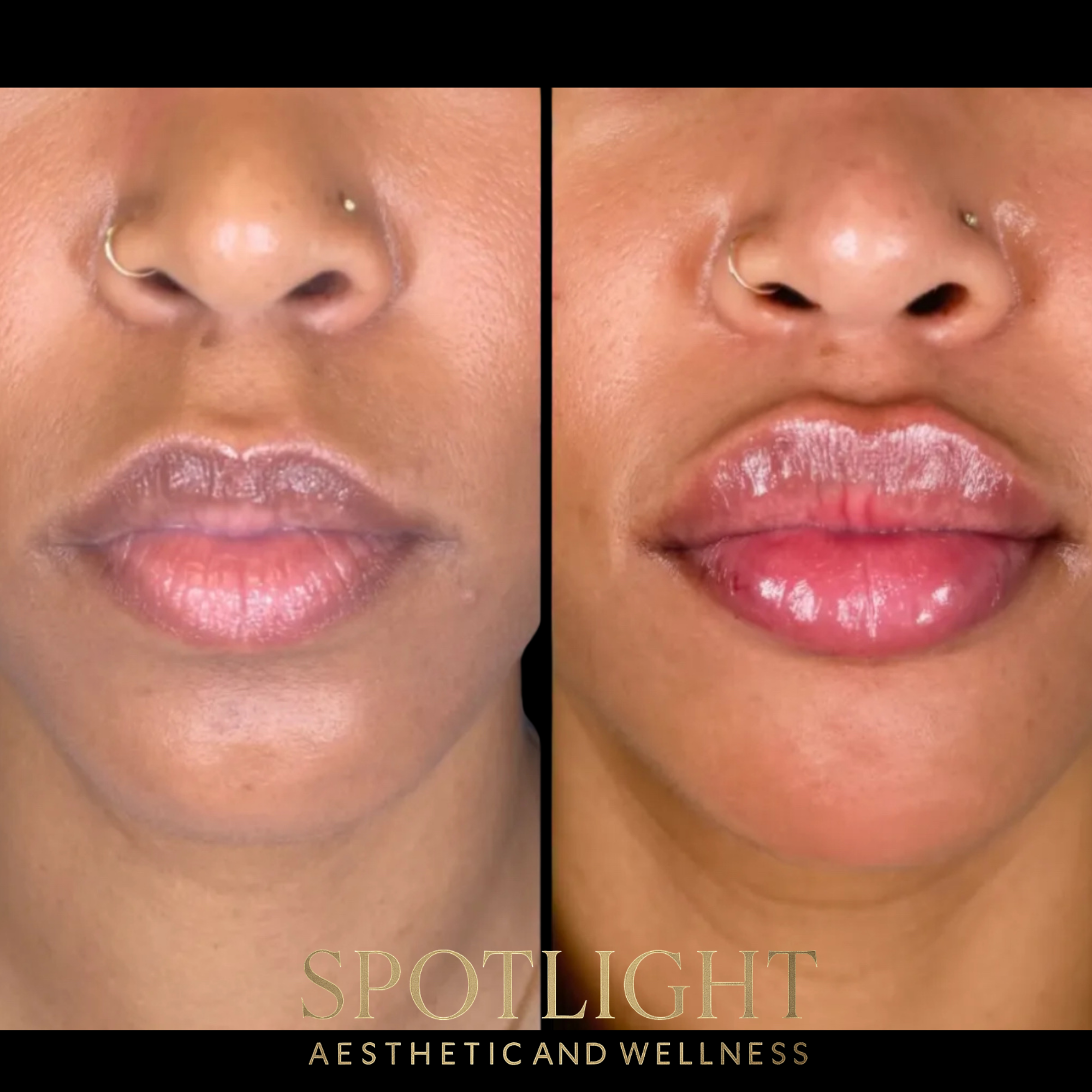Dramatic Lip Enhancement - Before and after aesthetic treatment results by Melissa Singleton PA-C