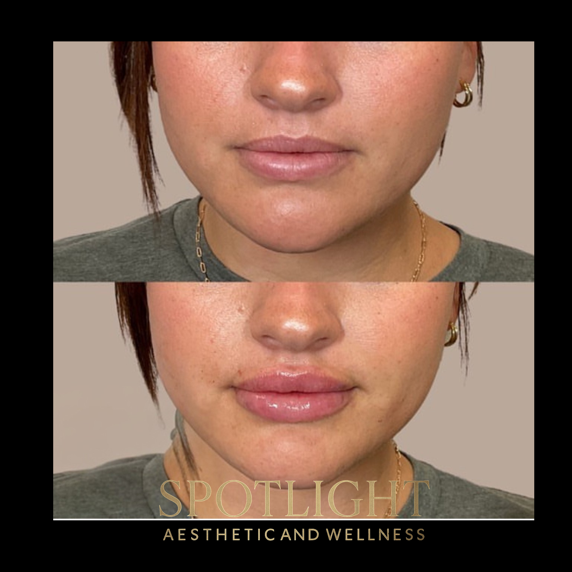 Subtle Lip Enhancement - Before and after aesthetic treatment results by Melissa Singleton PA-C