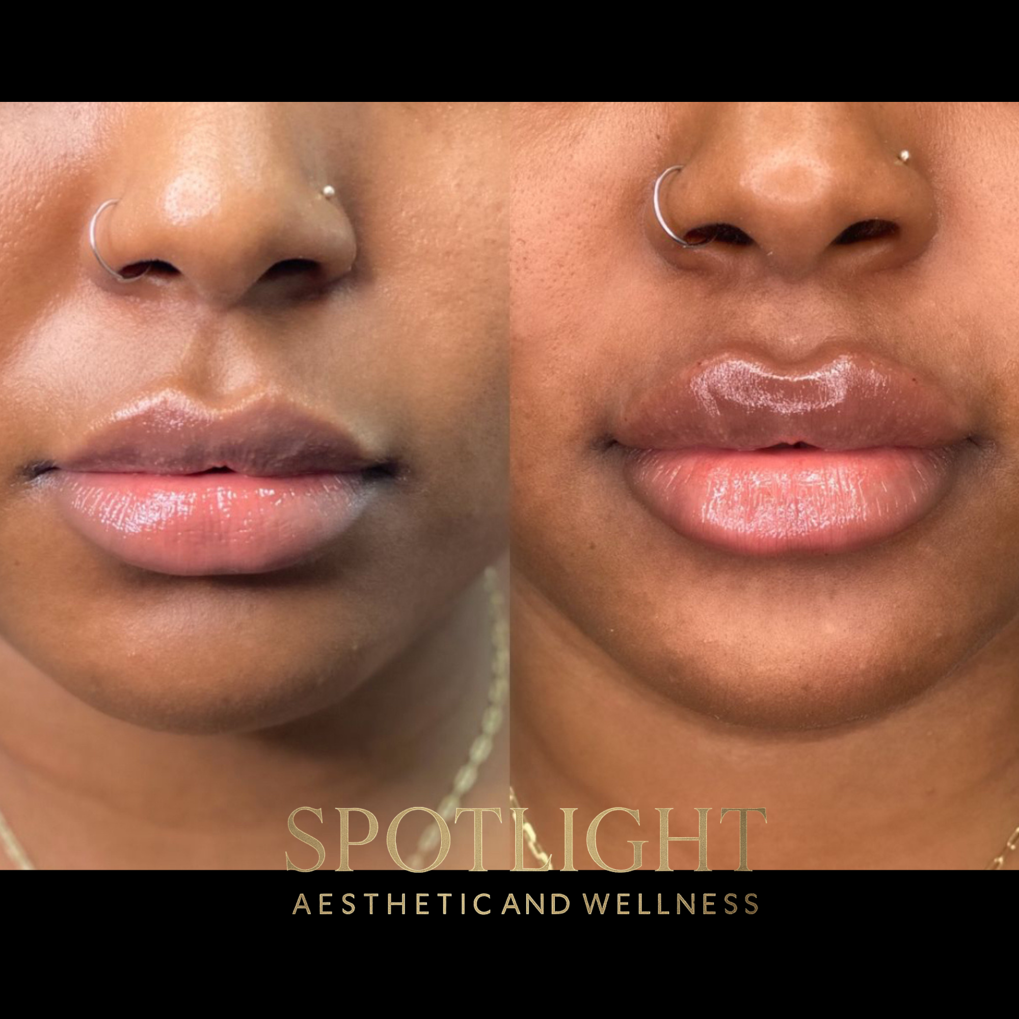 Lip Volume Restoration - Before and after aesthetic treatment results by Melissa Singleton PA-C