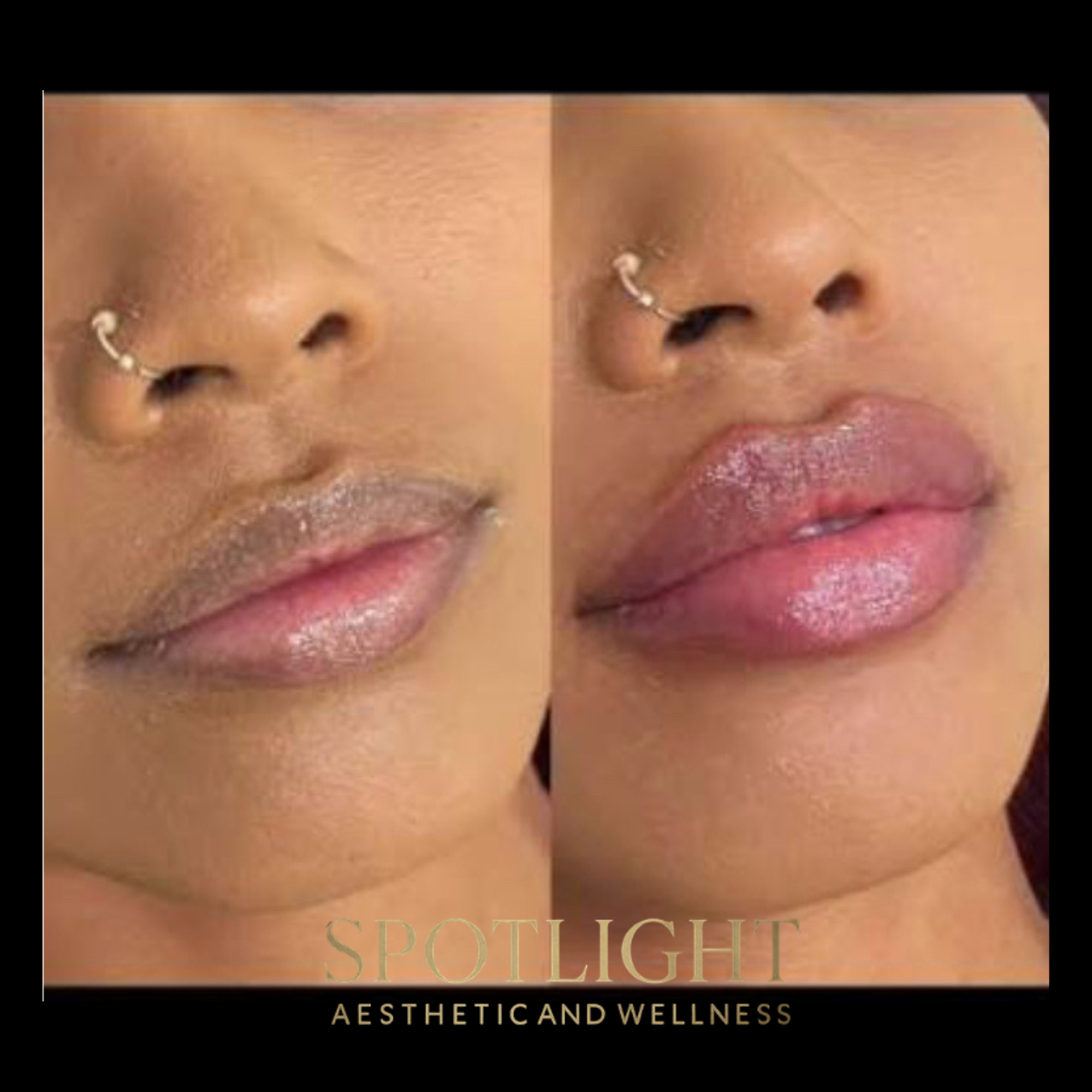 Lip Contouring - Before and after aesthetic treatment results by Melissa Singleton PA-C