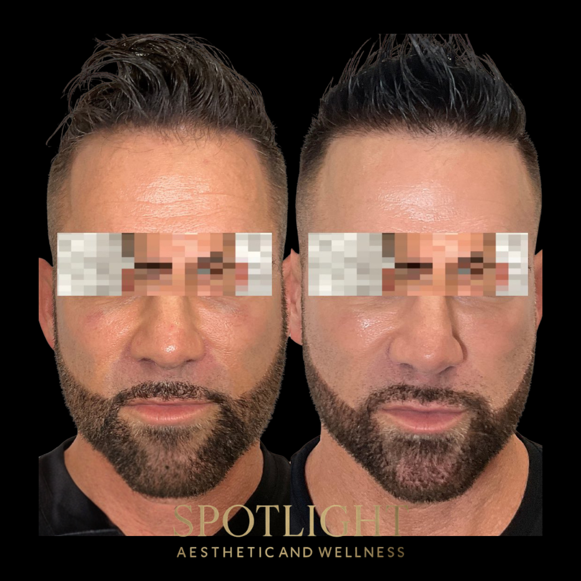 Male Facial Rejuvenation - Before and after aesthetic treatment results by Melissa Singleton PA-C