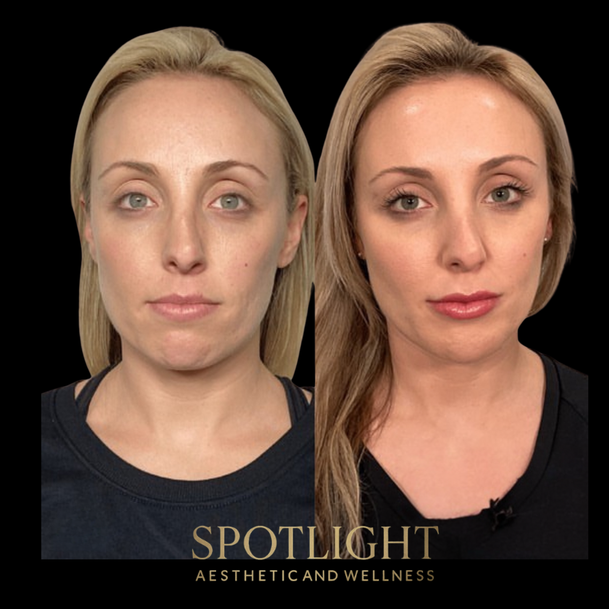 Dramatic Facial Volume Restoration - Before and after aesthetic treatment results by Melissa Singleton PA-C