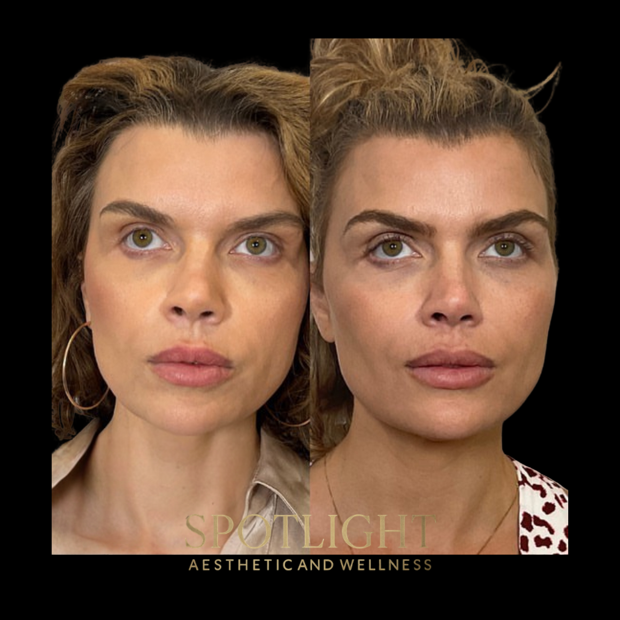 Natural Facial Enhancement - Before and after aesthetic treatment results by Melissa Singleton PA-C