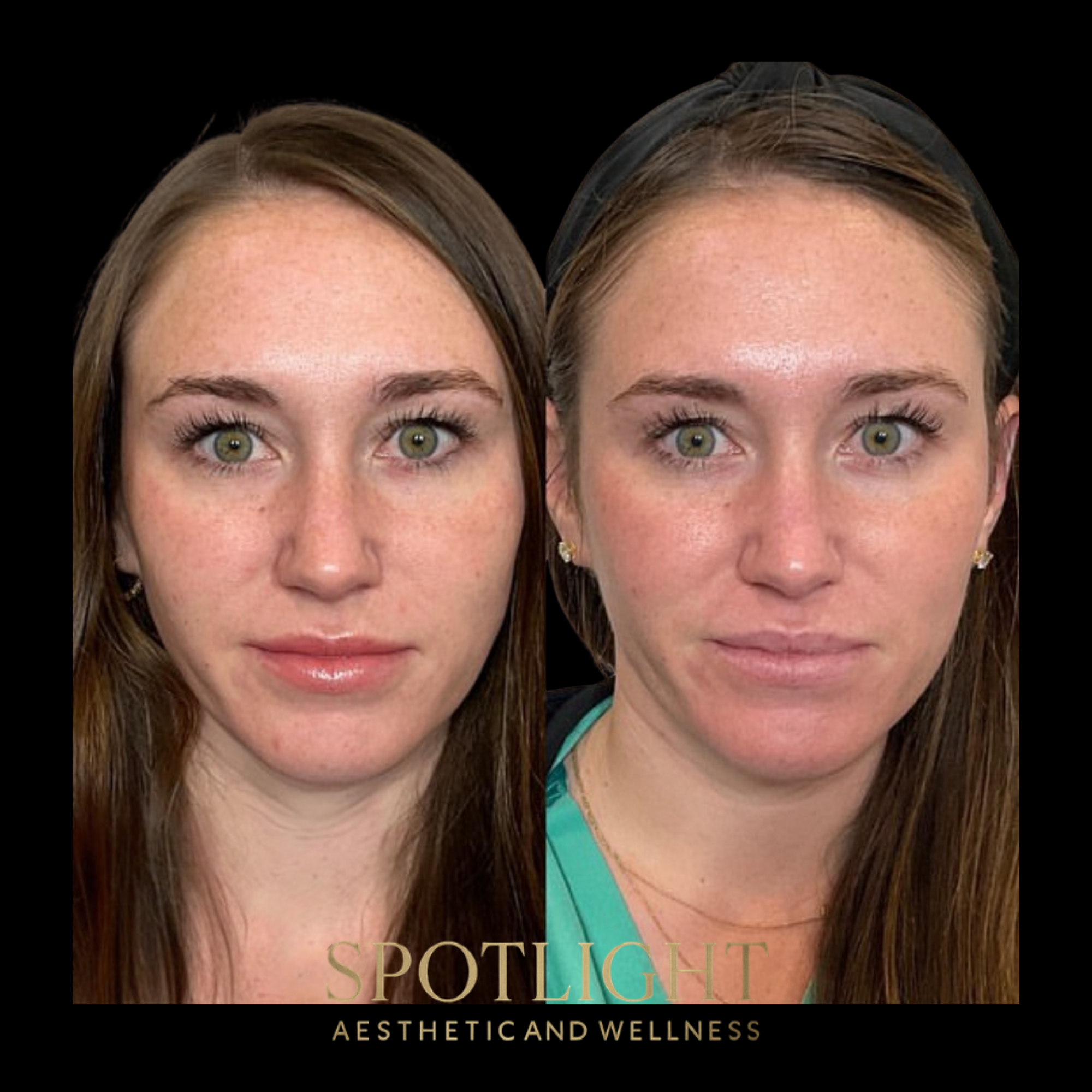 Youthful Facial Rejuvenation - Before and after aesthetic treatment results by Melissa Singleton PA-C