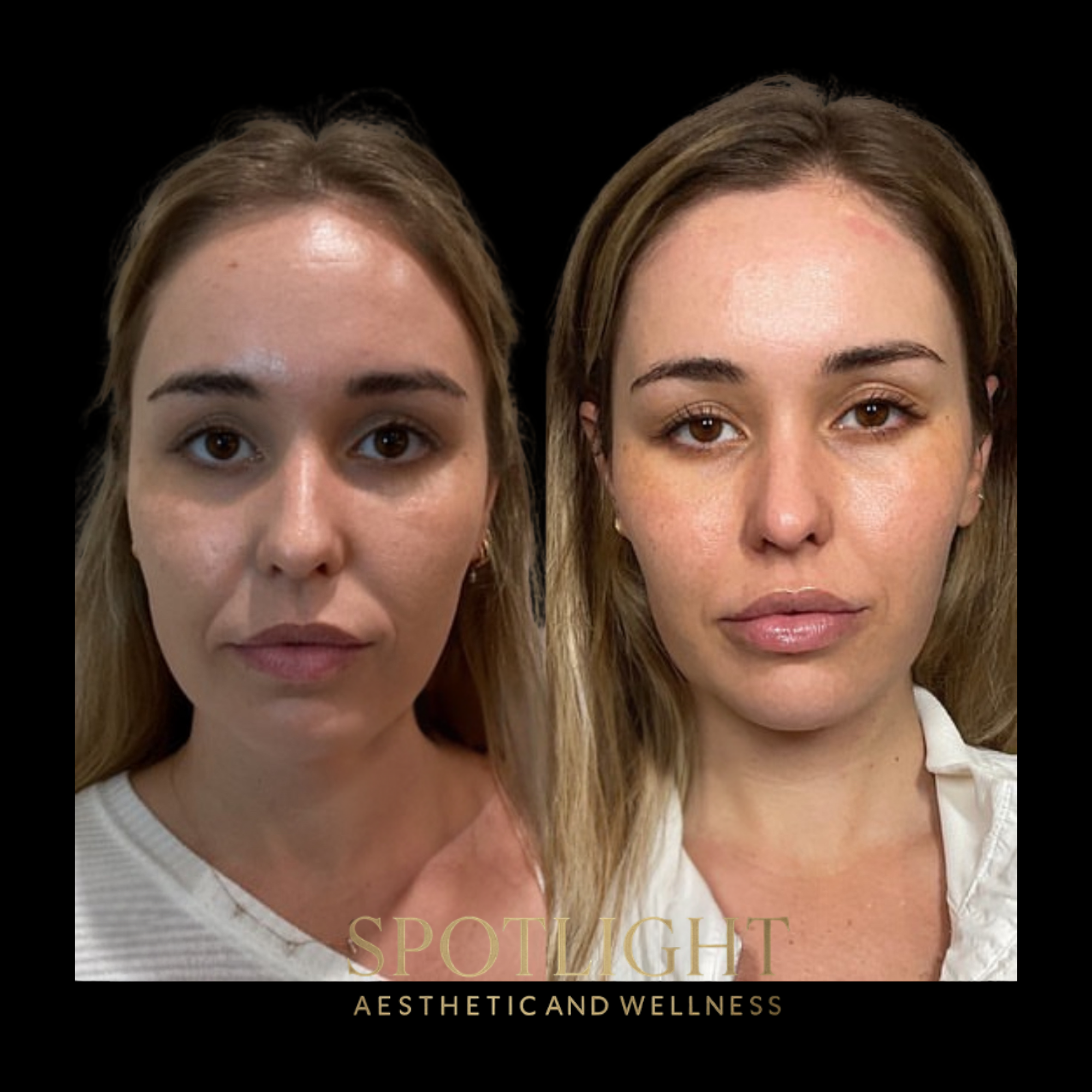 Complete Facial Transformation - Before and after aesthetic treatment results by Melissa Singleton PA-C