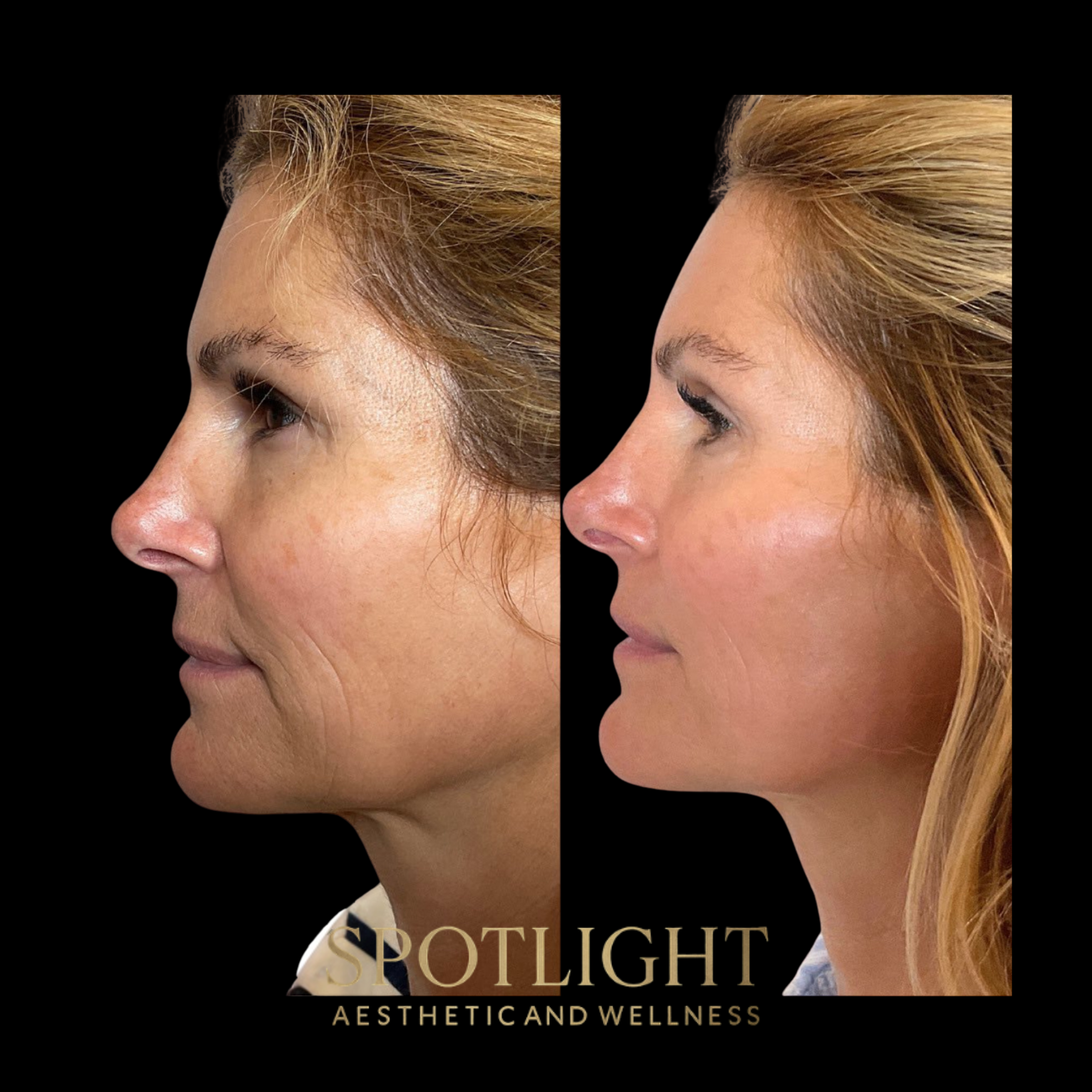 Sculptra Smile Line Reduction - Before and after aesthetic treatment results by Melissa Singleton PA-C