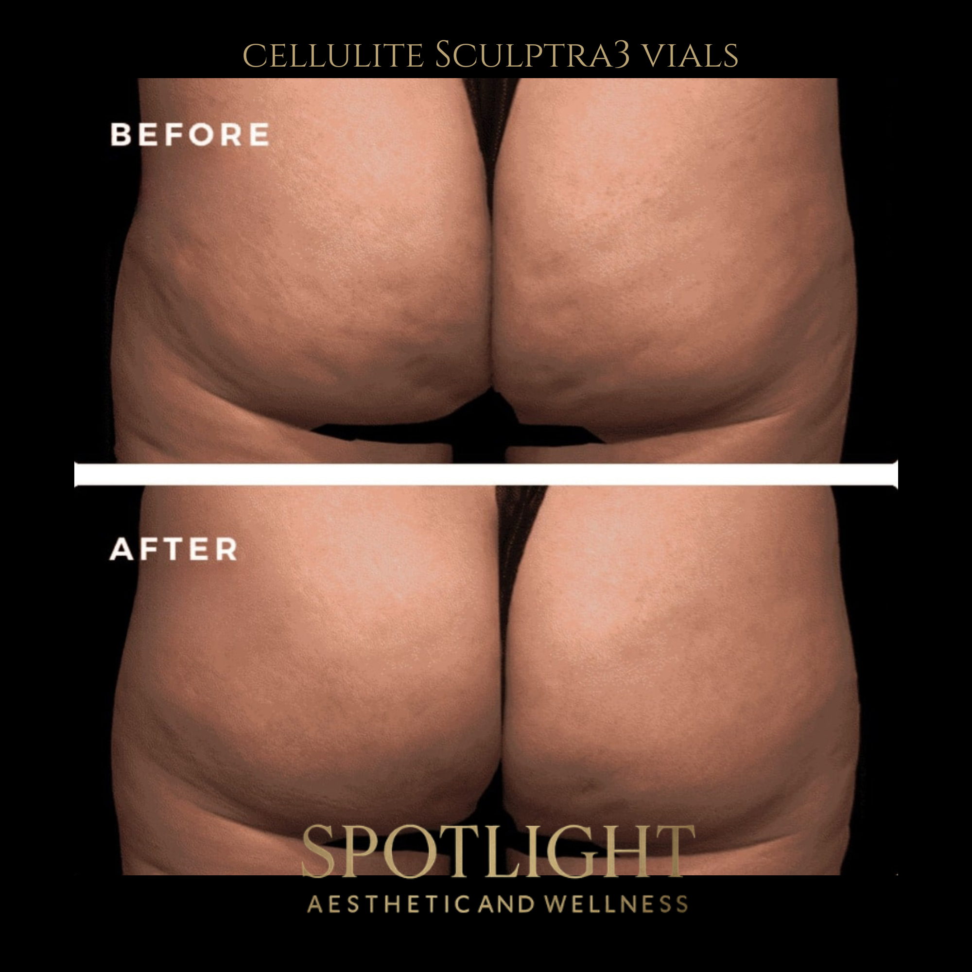 Cellulite Improvement - 3 Vials - Before and after aesthetic treatment results by Melissa Singleton PA-C