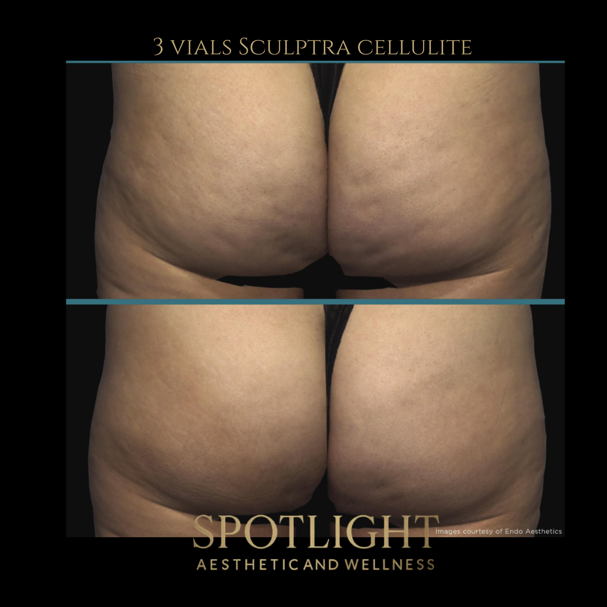 Cellulite Reduction - 3 Vials - Before and after aesthetic treatment results by Melissa Singleton PA-C