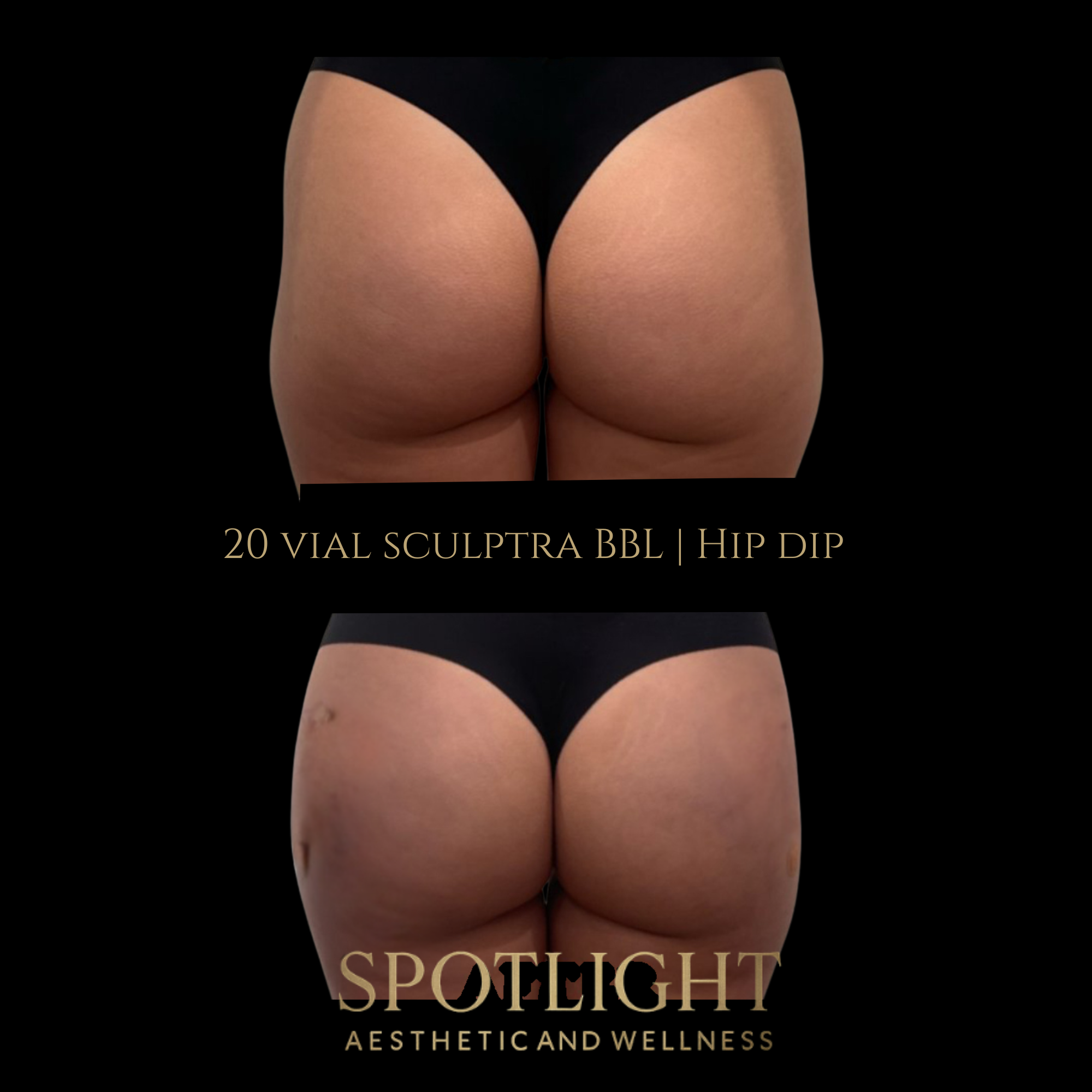 BBL & Hip Dip Enhancement - 20 Vials - Before and after aesthetic treatment results by Melissa Singleton PA-C