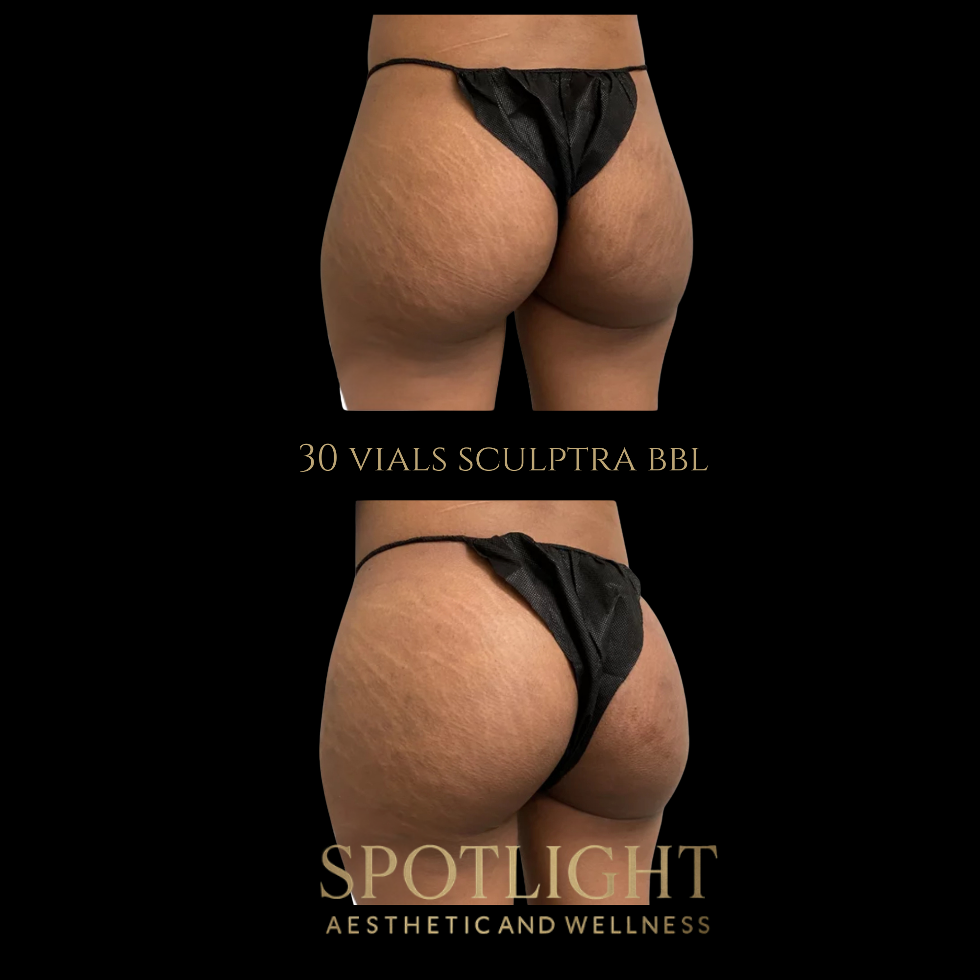 Dramatic BBL Enhancement - 30 Vials - Before and after aesthetic treatment results by Melissa Singleton PA-C