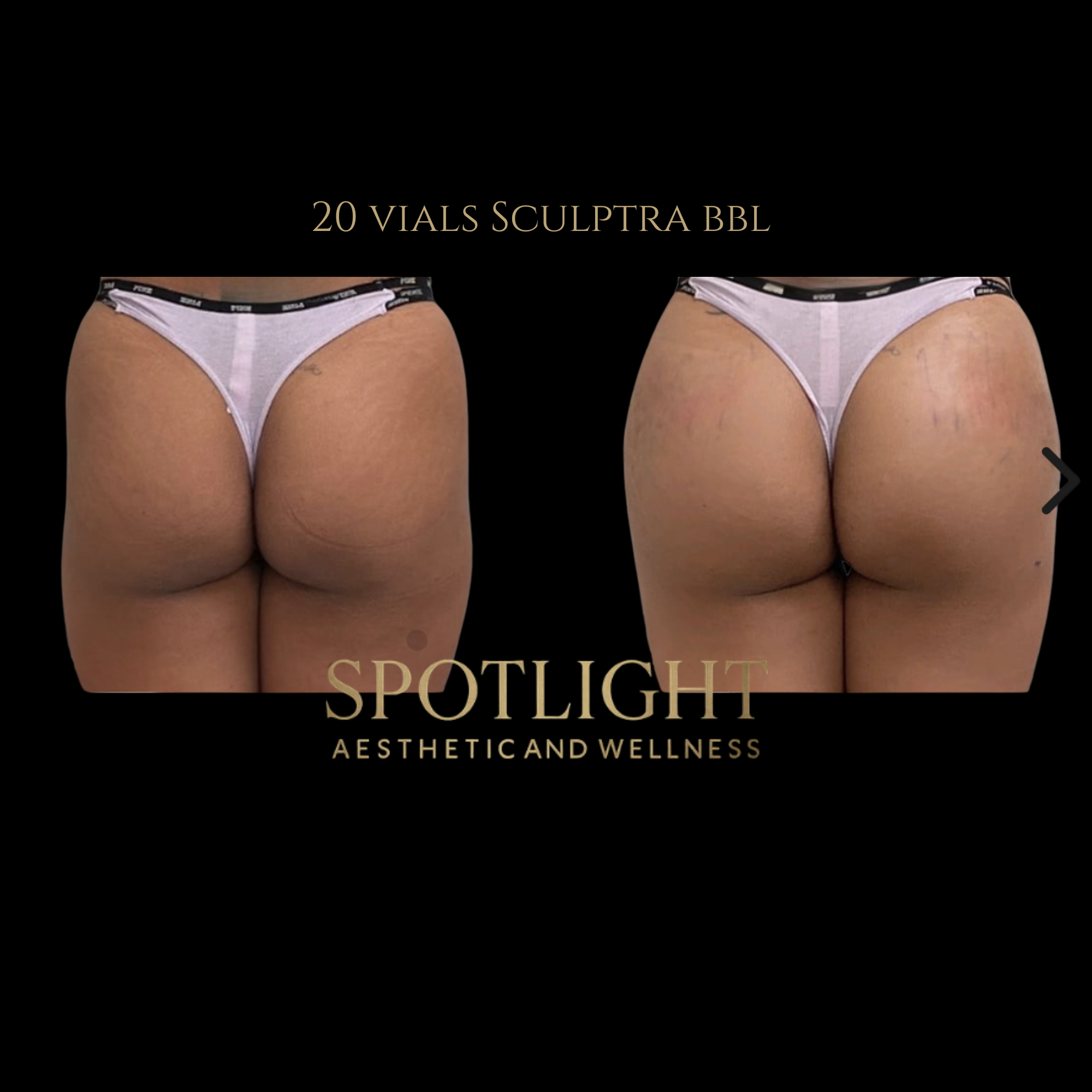 BBL Contouring - 20 Vials - Before and after aesthetic treatment results by Melissa Singleton PA-C