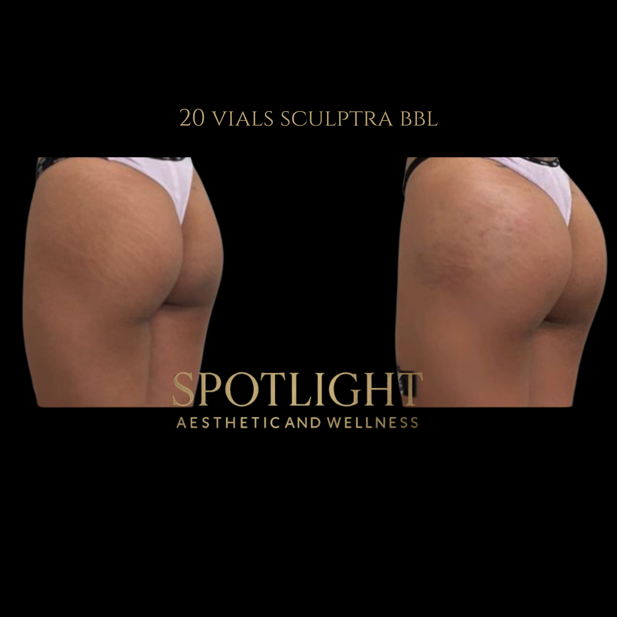 Profile BBL Enhancement - 20 Vials - Before and after aesthetic treatment results by Melissa Singleton PA-C