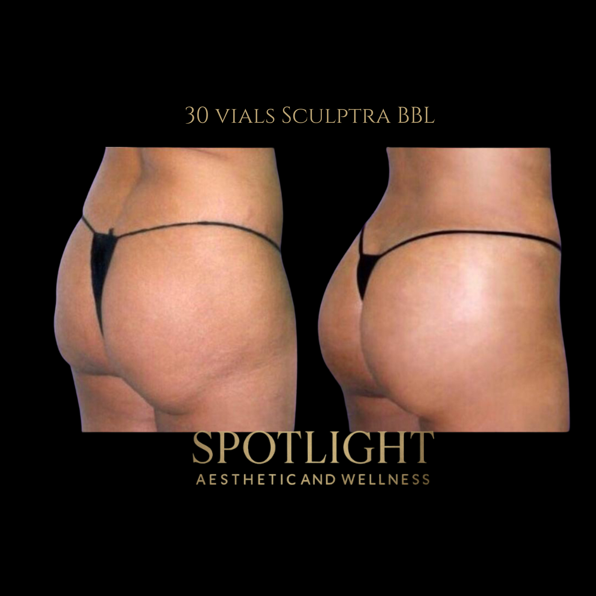 Comprehensive BBL - 30 Vials - Before and after aesthetic treatment results by Melissa Singleton PA-C
